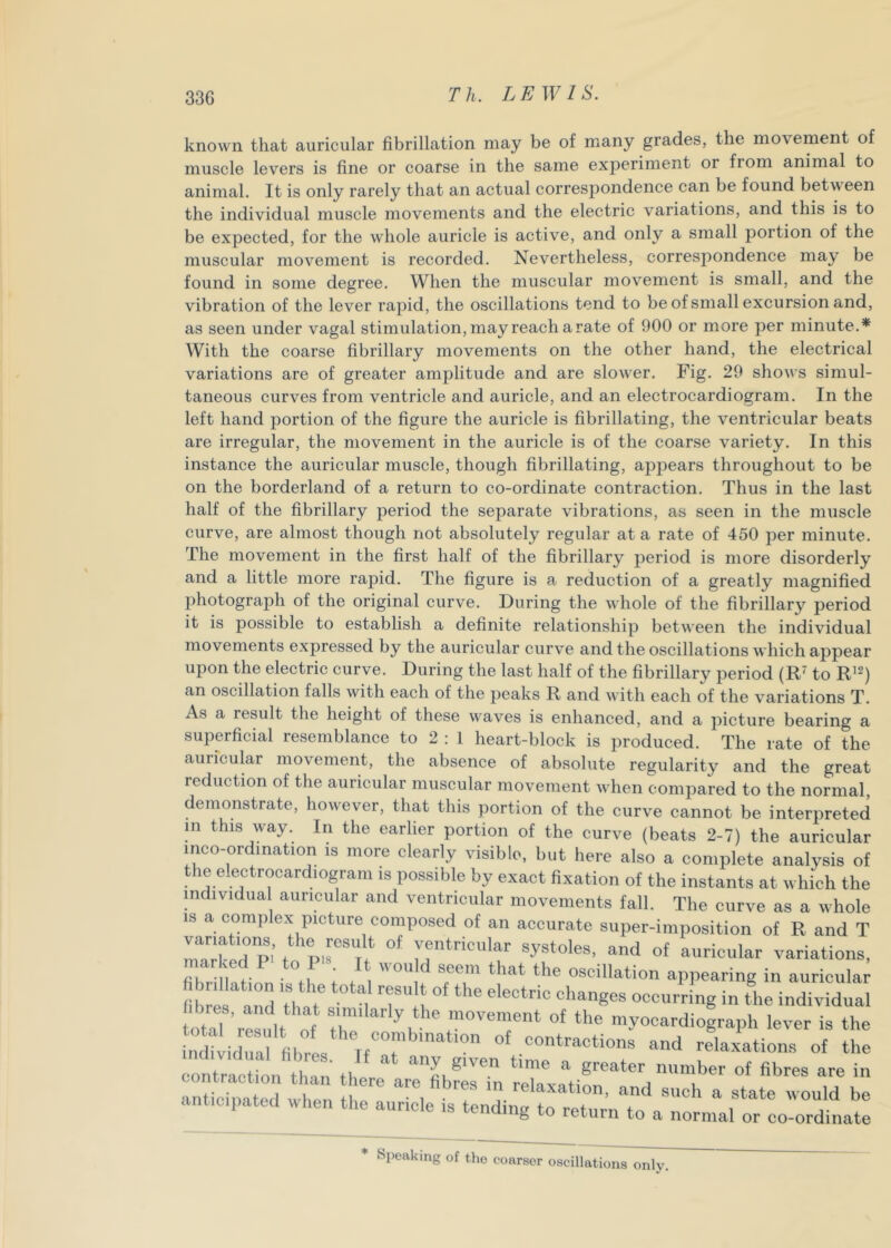 known that auricular fibrillation may be of many grades, the movement of muscle levers is fine or coarse in the same exjjeriment or from animal to animal. It is only rarely that an actual correspondence can be found between the individual muscle movements and the electric variations, and this is to be expected, for the whole auricle is active, and only a small portion of the muscular movement is recorded. Nevertheless, correspondence may be found in some degree. When the muscular movement is small, and the vibration of the lever rapid, the oscillations tend to be of small excursion and, as seen under vagal stimulation, may reach a rate of 900 or more per minute.* With the coarse fibrillary movements on the other hand, the electrical variations are of greater amplitude and are slower. Fig. 20 shows simul- taneous curves from ventricle and auricle, and an electrocardiogram. In the left hand portion of the figure the auricle is fibrillating, the ventricular beats are irregular, the movement in the auricle is of the coarse variety. In this instance the auricular muscle, though fibrillating, ap2:)ears throughout to be on the borderland of a return to co-ordinate contraction. Thus in the last half of the fibrillary period the separate vibrations, as seen in the muscle curve, are almost though not absolutely regular at a rate of 450 per minute. The movement in the first half of the fibrillary period is more disorderly and a little more rapid. The figure is a reduction of a greatly magnified photograph of the original curve. During the whole of the fibrillary period it is possible to establish a definite relationship between the individual movements expressed by the auricular curve and the oscillations which ajjpear upon the electric curve. During the last half of the fibrillary period (R' to R’^) an oscillation falls with each of the peaks R and with each of the variations T. As a result the height of these weaves is enhanced, and a picture bearing a superficial resemblance to 2 : 1 heart-block is produced. The rate of the auricular movement, the absence of absolute regularity and the great reduction of the auricular muscular movement when compared to the normal demonstrate, however, that this portion of the curve cannot be interpreted m this way. In the earlier portion of the curve (beats 2-7) the auricular mco-ordination is more clearly visible, but here also a complete analysis of the electrocardiogram is possible by exact fixation of the instants at which the individual auricular and ventricular movements fall. The curve as a whole IS a complex picture composed of an accurate super-imposition of R and T ‘rf° pi’t ‘ ventricular systoles, and of auricular variations, fik n f ■ seem that the oscillation appearing in auricular fibres*'and that* “''‘‘Re® occurring in the individual otaT’result of 'ovement of the myoeardiograph lever is the ndilidua fibres Tf™; ’“ “-'d relaxations of the contractfon 1^,' th fi’^-'es are in llc^a e when ! “*i T u- such a state would be ant.c.pated when the auricle is tending to return to a normal or co-ordinate Speaking of tlio coarser oscillations only.