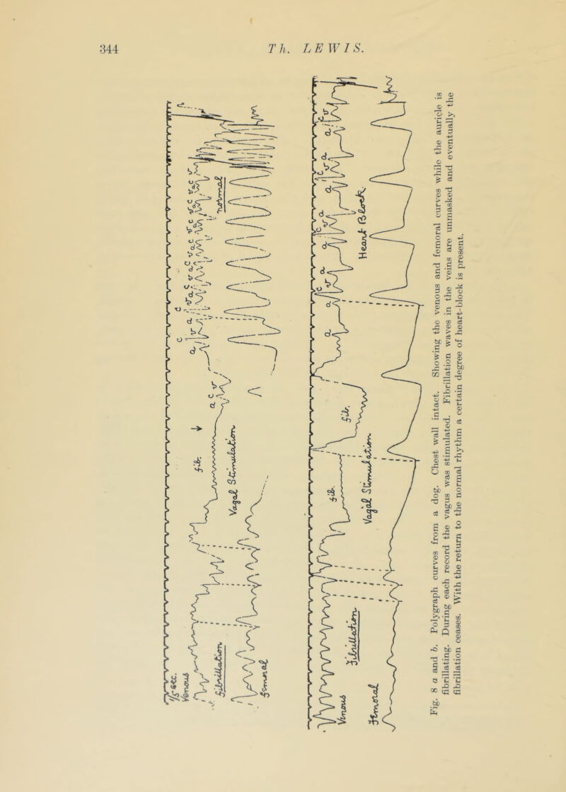 8 a and h. Polygraph curves from a dog. Chest wall intact. Showing the venous and femoral curves while the auricle is fibrillating. During each record the vagus was stimulated. Fibrillation waves in the veins are immasked and eventually the fibrillation ceases. With the return to the normal rhythm a certain degree of heart-block is present.