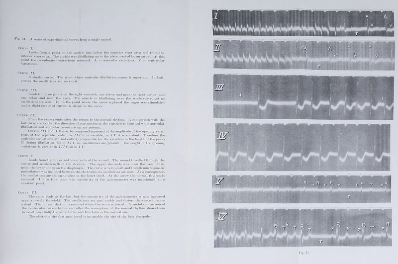 Fig. .il. A series t)f exjic'rimenlrtl curves from a single animal. Cuuvio r. Lo'acl.s from a j^niiit on the auricle just below the superior \'ena ca\a and from the inferior vena cava. The auricle was fibrillating u[> to the i)lace marked by an arrow. At this point the co-ordinate I'ontractions returned. A = auricular variations. V = ventricular variations. Curve II. A similar curve. The point where auricular fibrillation ceases is uncertain. In both curves the oscillations are maximal. Curve III. Leads from two jioints on the right ventricle, one above and near the right border, and one below and nel^r the apex. The auricle is fibrillating over the wliole curve, yet no oscillations are seen. to the iioint where the arrow is placed the vagus was stimulated and a slight escape of current is shown in the curve. Curve I V. From the same points after the return to the normal rhythm. A comparison with the last curve show's that the direction of contraction in the ventricle is identical wiiile auricular fibrillation and auricular co-ordination are ])resent. Curves III and I V maybe compared in respect of the amplitude of the opening varia- tions of the separate beats. In 171 it is variable, in 7 V it is constant. Therefore the auricular oscillations are not entirely responsible for the \'ariation in the height of the peaks R during fibrillation, for in III no oscillations are present. The height of the opening variations is greater in 777 than in 7 V. Curve V. Leads from the ujijier and low'er ends of the w'ound. The wound travelled through the centre and w'hole length of the stern\un. The upj)er electrode w'as upon the base of the neck, the low’er one upon the diapliragm. Tlie curve is very small and though much somatic musculature w'as included botw'een the electrodes, no oscillations are seen. As a consequence, the oscillations are showm to arise in the heart itself. At the arrow the normal rhythm is resumed. X^p to this point the sensitivity of the galvanometer was maintained at a constant point. Curve F7. The same leads as the last, but the sensitivity of the galvanometer is now' increased approximately threefold. The oscillations are just visible and distort the curve to some extent. The normal rhythm is resumed w'here the arrow' is placed. A careful comparison of the ventricular cm'ves before and after the resumihion of the normal rhythm show's them to be of essentially the same form, and this form is the normal one. The electrode site first mentioned is invariably the site of the base electrode. Fig. 31.
