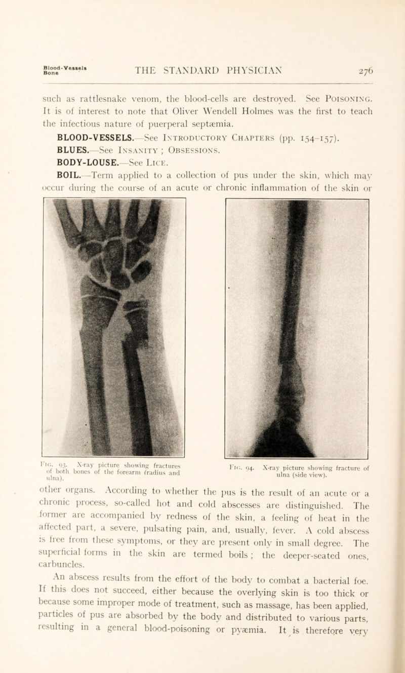 Blood-Vessela Bone THE STANDARD ITIYSICEW 276 such as rattlesnake venom, tlie blood-cells are destian'ed. See Poisoning. It is of interest to note that ()li\’er W’endell Holmes was the lirst to teach the infections nature of ]merperal se))tiemia. BLOOD-VESSELS. See Introductory Chapters (jjj). 154-157). BLUES. See Insanity; Obsessions. BODY-LOUSE. -See lacE. BOIL.—T erm applied to a collection of pus under the skin, which ma\’ occur during the course of an acute or chronic inflammation of the skin or ulna). otiiei oigans. According to whether the jius is the result of an acute or a chronic ])rocess, so-called hot and cold abscesses are distinguished. The former are accompanied by redness of the skin, a feeling of heat in the affected ])art, a severe, pulsating pain, and, usually, fever. A cold abscess IS liee fiom these symptoms, or they are ])resent onlv in small degree. The supeitidal foims in the skin are termed boils; the deej^ier-seated ones, carbuncles. An abscess lesults from the effort of the body to combat a liacterial foe. If this does not succeed, either because the overlying skin is too thick or because some improper mode of treatment, such as massage, has been applied, particles of pus are absorbed by the body and distributed to various parts, resulting in a general blood-poisoning or pya:mia. It is therefore very