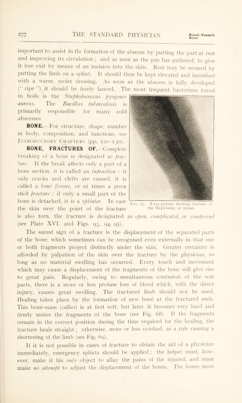 Bone important to assist in tlu formation of the abscess by ])iitting the j-iart at rest and impio\ing its ciiculation j and as soon as the ])iis has gathered, to give it free exit l)y means of an incision into the skin. Rest may l)c secured l)y putting tlie liml) on a splint. It should then be kept elevated and furnished with a warm, moist dressing. As soon as the abscess is fully developed (“ ripe ”) it should be freely lanced. The most frequent bacterium found in boils is the Staphylococcus pyogenes aureus. The Bacillus tuberculosis is primarily responsible for many cold abscesses. BONE.—For structure, shape, number in body, composition, and functions, see Introductory Chapters (pp. 120-iqo). BONE, FRACTURES OF.—Complete breaking ol a bone is designated as frac- ture. If the break affects onh’ a ])art of a bone section, it is called an i)ifraction : if only cracks and clefts are caused, it is called a hone fissure, or at times a green stick fracture ; if only a small ])art of the bone is detached, it is a splinter. In case the skin over the point of the fracture is also torn, the fracture is designated as open, coni plicated, or compound (see Plate X\T. and Figs. 93, 94, 95). The surest sign of a fracture is the displacement of the se})arated })arts of the bone, which sometimes can be recognised even externally in that one or both fragments project distinctly under the skin. (Greater certainty is afforded by palpation of the skin over the fracture by the physician, so long as no material swelling has occurred. Fvery touch and movement which may cause a displacement of the fragments of the bone will give rise to great pain. Regularly, owing to simultaneous contusion ot the soil parts, there is a more or less profuse loss of blood which, with the direct injury, causes great swelling. The fractured limb should not be used. Healing takes place by the formation of new bone at the fractured ends. This bone-mass (callus) is at first soft, but later it becomes very hard and firmly unites the fragments of the bone (see big. 68). If the fragments remain in the correct position during the time required for the healing, the fracture heals straight ; otherwise, more or less crooked, as a rule causing a shortening of the limb (see Fig. 69). If it is not possible in cases of fracture to obtain the aid of a physician immediately, emergency siilints should be applied ; the helper must, how- ever, make it his only object to allay the pains of the injured, and must make no attempt to adjust the displacement of the bones. The bones most