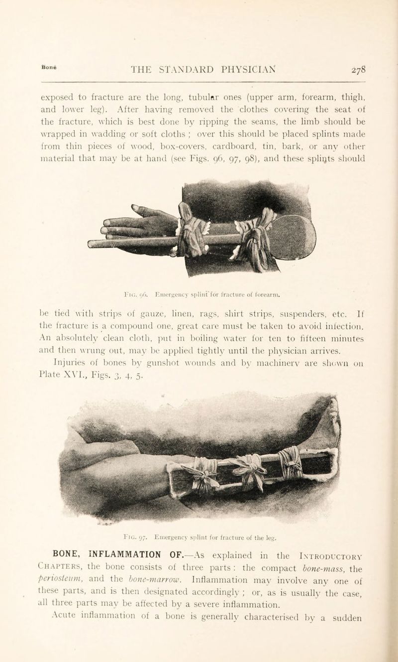 exposed to fracture are the long, tubular ones (upper arm, forearm, thigli, and lower leg). After having removed the clothes covering the seat of the fracture, which is best done bv rip])ing the seams, the limb should be wrapped in wadding or soft cloths ; o\’er this should be ])laced splints made from thin ]deces of wood, box-covers, cardboard, tin, bark, or anv other material that ma}’ be at hand (see h'igs. 96, 97, 98), and these spliips should ]'i(:. 96. lOueri^ency spliiit’for J'nicture of fort*;\nii. be tied with stri])s of gauze, linen, rags, shirt stri])s, suspenders, etc. If the fracture is a compound one, great care must be taken to a\’oid infection. An absolutely clean cloth, put in boiling water for ten to fifteen minutes and then wrung out, may be a])y)lied tightlv until the }di}'sician arrives. Injuries of bones bv gunshot wounds and b\' macliinerv are shown on Plate XYl., Figs. 3, 4, 5- I'lG. 97. lOiiergency .s!)]int for fracture of tlie le.e. BONE, INFLAMMATION OF.—As explained in the Introductory Chapters, the bone consists of three parts: the compact hone-mass, the perwsteii})i, and the bone-marrow. Inflammation ma\’ involve anv one of these parts, and is then designated accordingly ; or, as is usually the case, all three parts may be affected by a severe inflammation. Acute inflammation of a bone is generally characterised by a sudden