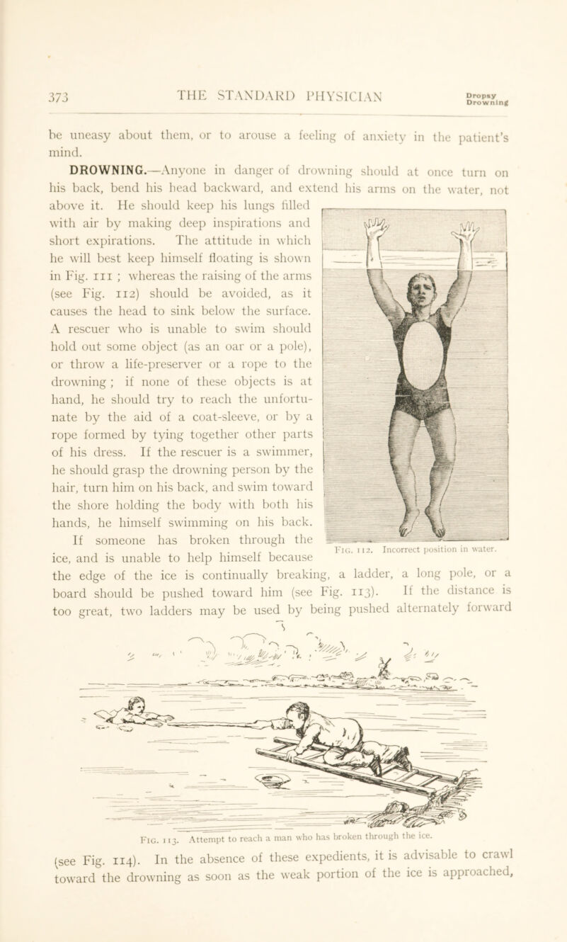 Drowning be uneasy about them, or to arouse a feeling of anxiety in the patient’s mind. DROWNING.—Anyone in danger of drowning should at once turn on his back, bend his head backward, and extend his arms on the water, not above it. He should keep his lungs filled with air by making deep inspirations and short expirations. The attitude in which he will best keep himself tloating is shown in Fig. Ill ; wdiereas the raising of the arms (see Fig. 112) should be avoided, as it causes the head to sink below the surface. A rescuer who is unable to swim should hold out some object (as an oar or a pole), or throw a life-preserver or a rope to the drowning ; if none of these objects is at hand, he should try to reach the unfortu- nate by the aid of a coat-sleeve, or by a rope formed by tying together other parts of his dress. If the rescuer is a swimmer, he should grasp the drowning person by the hair, turn him on his back, and swim toward the shore holding the body with both his hands, he himself swimming on his back. If someone has broken through the ice, and is unable to help himself because the edge of the ice is continually breaking, a ladder, a long pole, or a board should be pushed toward him (see Idg. 113)- distance is too great, two ladders may be used by being pushed alternately forward s (see Fig. 114). In the absence of these expedients, it is advisable to craw’l toward the drowming as soon as the weak portion of the ice is approached.