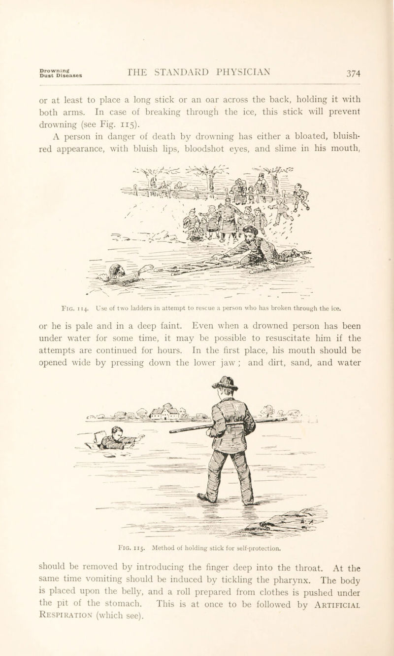 Drowning Dust Diseases IRE STANDARD PHYSICIAN 374 or at least to place a long stick or an oar across the back, holding it with both arms. In case of breaking through the ice, this stick will prevent drowning (see Fig. 115). A person in danger of death by drowning has either a bloated, bluish- red appearance, with bluish lips, bloodshot eyes, and slime in his mouth, or he is pale and in a deep faint. Even when a drowned person has been under water for some time, it may be possible to resuscitate him if the attempts are continued for hours. In the first place, his mouth should be opened wide by pressing down the lower jaw ; and dirt, sand, and water Fig. 115. Method of holding stick for self-protection. should be removed by introducing the finger deep into the throat. At the same time vomiting should be induced by tickling the pharynx. The body is placed upon the belly, and a roll prepared from clothes is pushed under the pit of the stomach. This is at once to be followed by Artificial Respiration (which see).