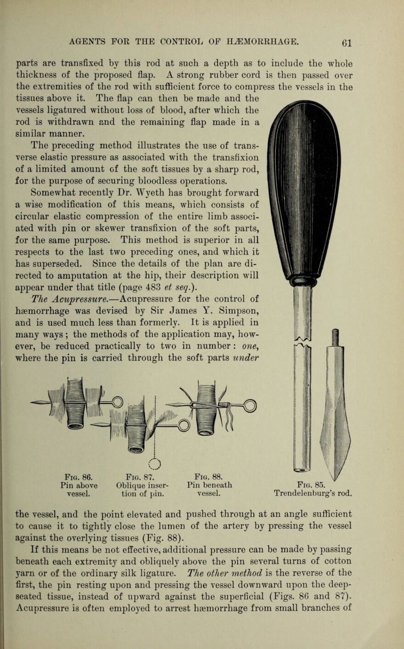 Fig. 86. Pin above vessel. Fig. 87. Oblique inser- tion of pin. Fig. 88. Pin beneath vessel. parts are transfixed by this rod at such a depth as to include the whole thickness of the proposed flap. A strong rubber cord is then passed over the extremities of the rod with sufficient force to compress the vessels in the tissues above it. The flap can then be made and the vessels ligatured without loss of blood, after which the rod is withdrawn and the remaining flap made in a similar manner. The preceding method illustrates the use of trans- verse elastic pressure as associated with the transfixion of a limited amount of the soft tissues by a sharp rod, for the purpose of securing bloodless operations. Somewhat recently Dr. Wyeth has brought forward a wise modification of this means, which consists of circular elastic compression of the entire limb associ- ated with pin or skewer transfixion of the soft parts, for the same purpose. This method is superior in all respects to the last two preceding ones, and which it has superseded. Since the details of the plan are di- rected to amputation at the hip, their description will appear under that title (page 483 et seq.). The Acupressure.—Acupressure for the control of haemorrhage was devised by Sir James Y. Simpson, and is used much less than formerly. It is applied in many ways ; the methods of the application may, how- ever, be reduced practically to two in number: one., where the pin is carried through the soft parts under KVi^ Fig. 85. Trendelenburg’s rod. the vessel, and the point elevated and pushed through at an angle sufficient to cause it to tightly close the lumen of the artery by pressing the vessel against the overlying tissues (Fig. 88). If this means be not effective, additional pressure can be made by passing beneath each extremity and obliquely above the pin several turns of cotton yarn or of the ordinary silk ligature. The other method is the reverse of the first, the pin resting upon and pressing the vessel downward upon the deep- seated tissue, instead of upward against the superficial (Figs. 86 and 87). Acupressure is often employed to arrest haemorrhage from small branches of