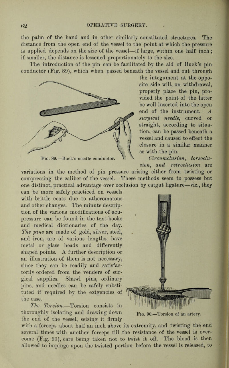 the palm of the hand and in other similarly constituted structures. The distance from the open end of the vessel to the point at which the pressure is applied depends on the size of the vessel—if large, within one half inch; if smaller, the distance is lessened proportionately to the size. The introduction of the pin can be facilitated by the aid of Buck’s pin conductor (Fig. 89), which when passed beneath the vessel and out through the integument at the oppo- site side will, on withdrawal, properly place the pin, pro- vided the point of the latter be well inserted into the open end of the instrument. A surgical needle^ curved or straight, according to situa- tion, can be passed beneath a vessel and caused to effect the closure in a similar manner as with the pin. Circumclusion^ torsoclu- sion, and retroclusion are variations in the method of pin pressure arising either from twisting or compressing the caliber of the vessel. These methods seem to possess but one distinct, practical advantage over occlusion by catgut ligature—viz., they can be more safely practiced on vessels with brittle coats due to atheromatous and other changes. The minute descrip- tion of the various modifications of acu- pressure can be found in the text-books and medical dictionaries of the day. The pins are made of gold, silver, steel, and iron, are of various lengths, have metal or glass heads and differently shaped points. A further description or an illustration of them is not necessary, since they can be readily and satisfac- torily ordered from the venders of sur- gical supplies. Shawl pins, ordinary pins, and needles can be safely substi- tuted if required by the exigencies of the case. The Torsion.—Torsion consists in thoroughly isolating and drawing down 90.—Torsion of an artery, the end of the vessel, seizing it firmly with a forceps about half an inch above its extremity, and twisting the end several times with another forceps till the resistance of the vessel is over- come (Fig. 90), care being taken not to twist it off. The blood is then allowed to impinge upon the twisted portion before the vessel is released, to