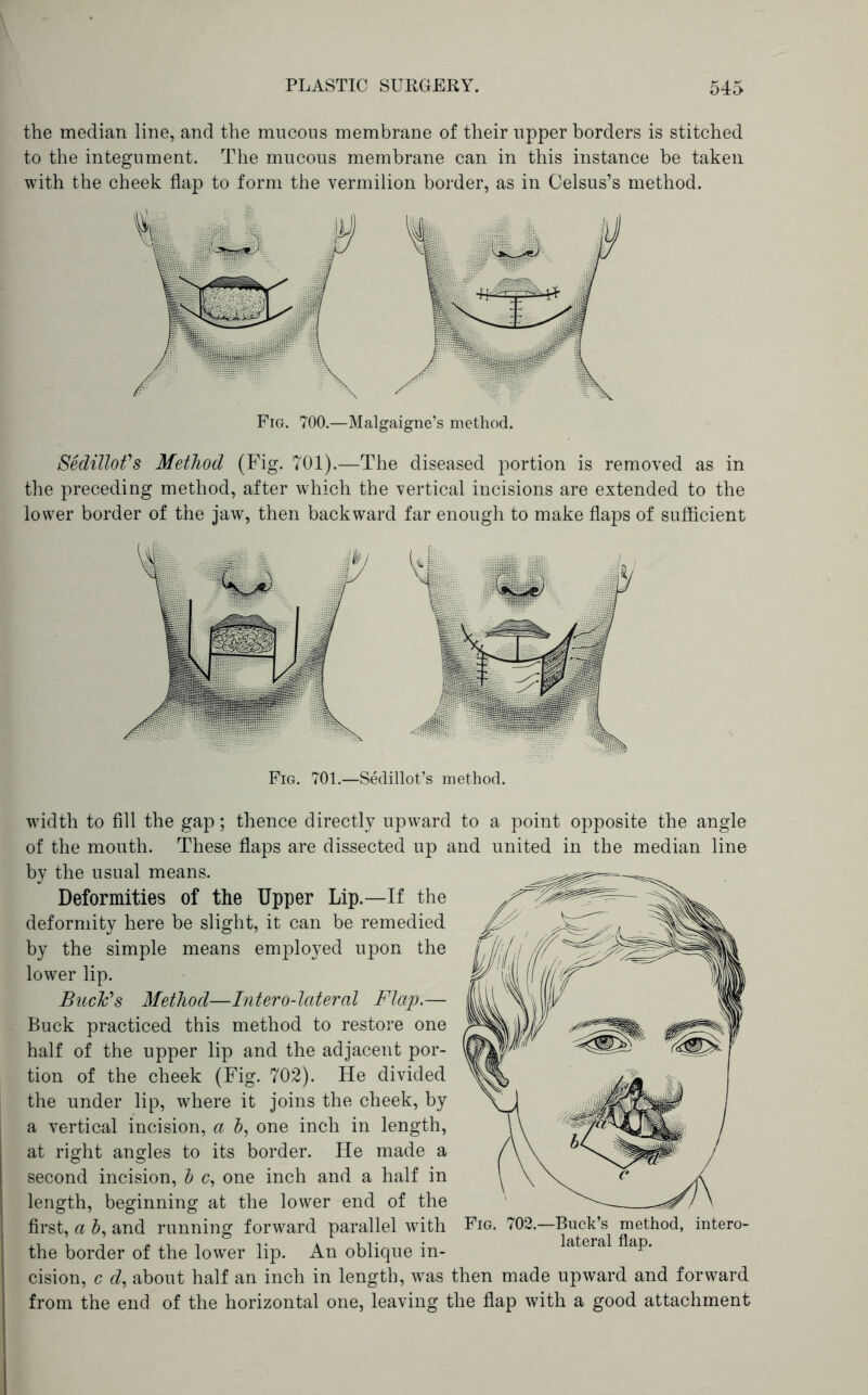 the median line, and the mucous membrane of their upper borders is stitched to the integument. The mucous membrane can in this instance be taken with the cheek flap to form the vermilion border, as in Celsus’s method. Fig. 700.—Malgaigne’s method. SediUofs Method (Fig. 701).—The diseased portion is removed as in the preceding method, after which the vertical incisions are extended to the lower border of the jaw, then backward far enough to make flaps of sufficient Fig. 701.—SMillot’s method. width to All the gap; thence directly upward to a point opposite the angle of the mouth. These flaps are dissected up and united in the median line by the usual means. Deformities of the Upper Lip.—If the deformity here be slight, it can be remedied by the simple means employed upon the lower lip. Buck's Method—Intero-lateral Flap.— Buck practiced this method to restore one half of the upper lip and the adjacent por- tion of the cheek (Fig. 702). He divided the under lip, where it joins the cheek, by a vertical incision, a J, one inch in length, at right angles to its border. He made a second incision, h c, one inch and a half in length, beginning at the lower end of the first, a and running forward parallel with the border of the lower lip. An oblique in- cision, c tZ, about half an inch in length, was then made upward and forward from the end of the horizontal one, leaving the flap with a good attachment Fig. 702.—Buck’s method, intero- lateral flap.
