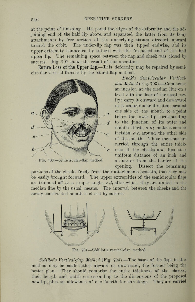 at the point of finishing. He pared the edges of the deformity and the ad- joining end of the half lip above, and separated the latter from its bony attachments by free section of the underlying tissues directed upward toward the orbit. The under-lip fiap was then tipped endwise, and its upper extremity connected by sutures with the freshened end of the half upper lip. The remaining space between the fiap and cheek was closed by sutures. Fig. 707 shows the result of this operation. Entire Loss of the Upper Lip.—This deformity may be repaired by semi- circular vertical fiaps or by the lateral- Fig. 703.—Semicircular-flap method. portions of the cheeks freely from their be easily brought forward. The upper are trimmed off at a proper angle, e d. median line by the usual means. The newly constructed mouth is closed by sn fiap method. Buclds Semicircular Vertical- flap Method (Fig. 703).—Commence an incision at the median line on a level with the floor of the nasal cav- ity ; carry it outward and downward in a semicircular direction around one side of the mouth to a point below the lower lip corresponding to the junction of its outer and middle thirds, a b; make a similar incision, a c, around the other side of the mouth. These incisions are carried through the entire thick- ness of the cheeks and lips at a uniform distance of an inch and a quarter from the border of the opening. Dissect the remaining attachments beneath, that they may extremities of the semicircular flaps after which they are united in the interval between the cheeks and the tures. Fig. 704.—Sedillot’s vertical-flap method. Sedillofs Vertical-flap Method (Fig. 704).—The bases of the flaps in this method may be made either upward or downward, the former being the better plan. They should comprise the entire thickness of the cheeks; their length and width corresponding to the dimensions of the proposed new lip, plus an allowance of one fourth for shrinkage. They are carried
