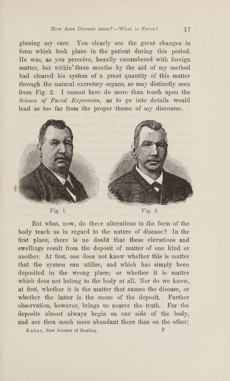 ginning my cure. You clearly see the great changes in form which took place in the patient during this period. He was, as you perceive, heavily encumbered with foreign matter, but within” three months by the aid of my method had cleared his system of a great quantity of this matter through the natural excretory organs, as may distinctly seen from Fig. 2. I cannot here do more than touch upon the Science of Facial Expression, as to go into details would lead us too far from the proper theme of my discourse. But what, now, do thece alterations in the form of the body teach us in regard to the nature of disease? In the first place, there is no doubt that these elevations and swellings result from the deposit of matter of one kind or another. At first, one does not know whether this is matter that the system can utilise, and which has simply been deposited in the wrong place; or whether it is matter which does not belong to the body at all. Nor do we know, at first, whether it is the matter that causes the disease, or whether the latter is the cause of the deposit. Further observation, however, brings us nearer the truth. For the deposits almost always begin on one side of the body, and are then much more abundant there than on the other;
