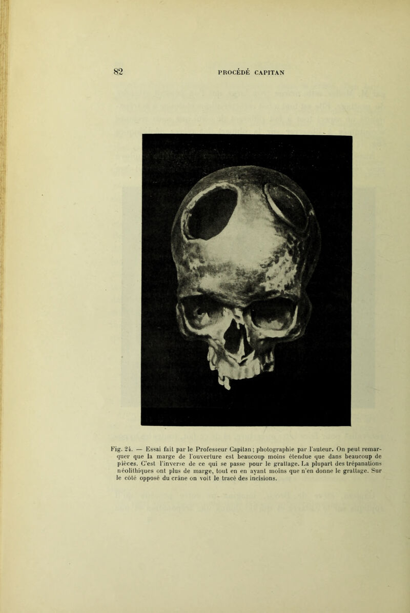 Fig. 24. — Essai fait parle Professeur Gapitan; photographie par l'auteur. On peut remar- quer que la marge de l'ouverture est beaucoup moins étendue que dans beaucoup de pièces. C’est l’inverse de ce qui se passe pour le grattage. La plupart des trépanations néolithiques ont plus de marge, tout en en ayant moins que n'en donne le grattage. Sui- te côté opposé du crâne on voit le tracé des incisions.