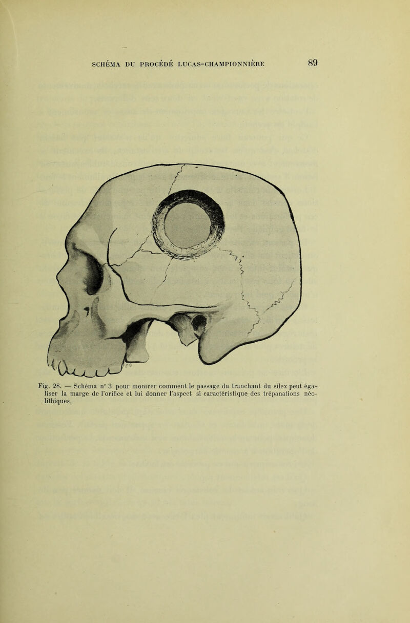 Fig. 28. — Schéma n“ .3 pour montrer comment le passage du tranchant du silex peut éga- liser la marge de l’orifice et lui donner l’aspect Si caractéristique des trépanations néo- lithiques.