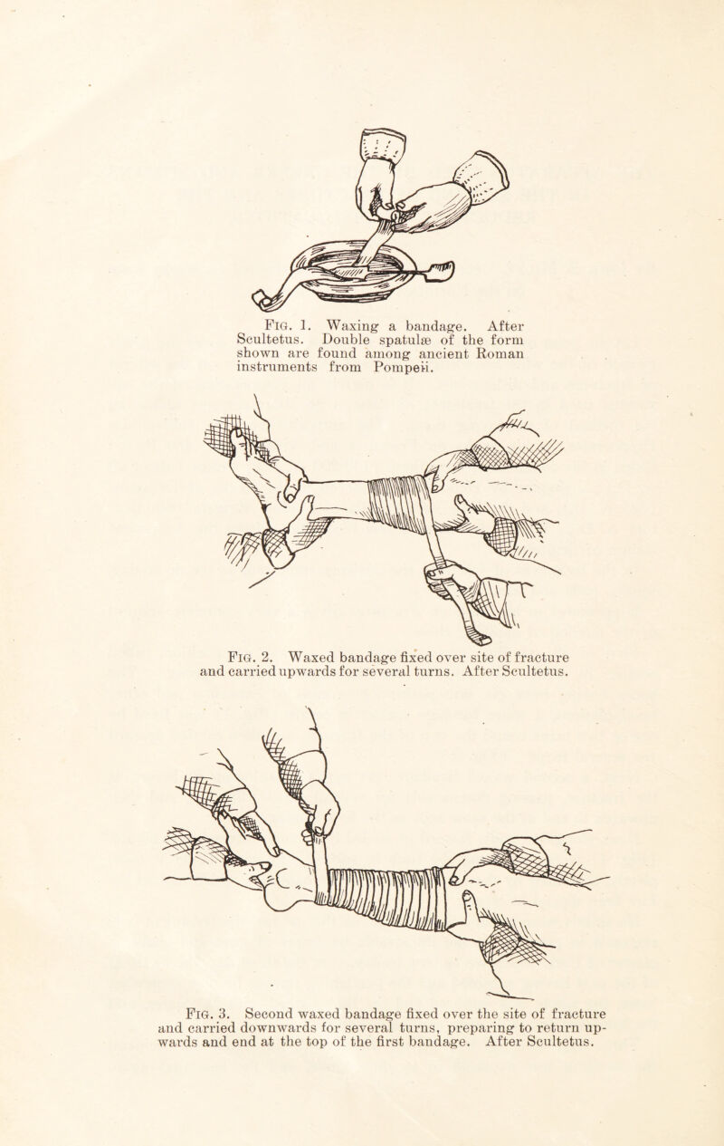 Fig. 1. Waxing- a bandage. After Scultetus. Double spatulse of the form shown are found among ancient Roman instruments from Pompeii. Pig. 2. Waxed bandage fixed over site of fracture and carried upwards for several turns. After Scultetus. Pig. 3. Second waxed bandage fixed over the site of fracture and carried downwards for several turns, preparing to return up- wards and end at the top of the first bandage. After Scultetus.