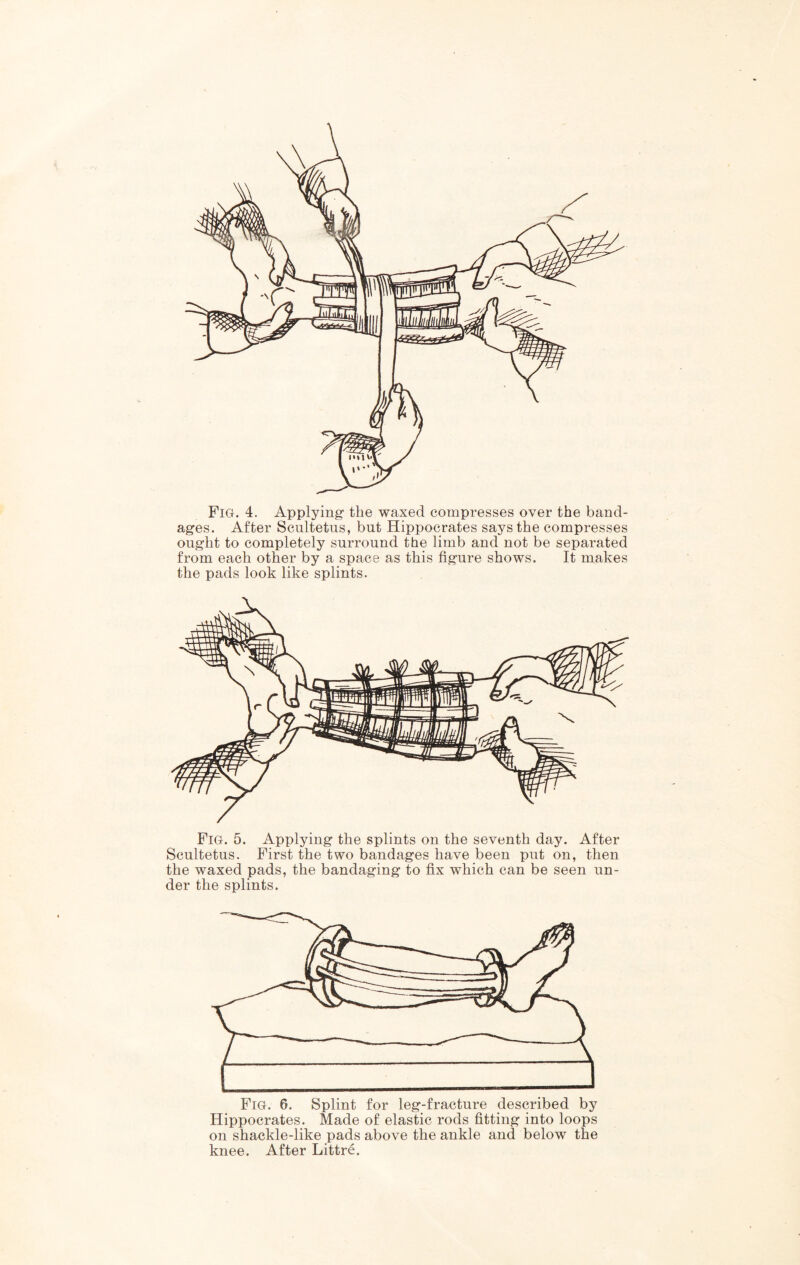 Fig. 4. Applying the waxed compresses over the band- ages. After Scultetus, but Hippocrates says the compresses ought to completely surround the limb and not be separated from each other by a space as this figure shows. It makes the pads look like splints. Pig. 5. Applying the splints on the seventh day. After Scultetus. First the two bandages have been put on, then the waxed pads, the bandaging to fix which can be seen un- der the splints. Fig. 6. Splint for leg-fracture described by Hippocrates. Made of elastic rods fitting into loops on shackle-like pads above the ankle and below the knee. After Littre.