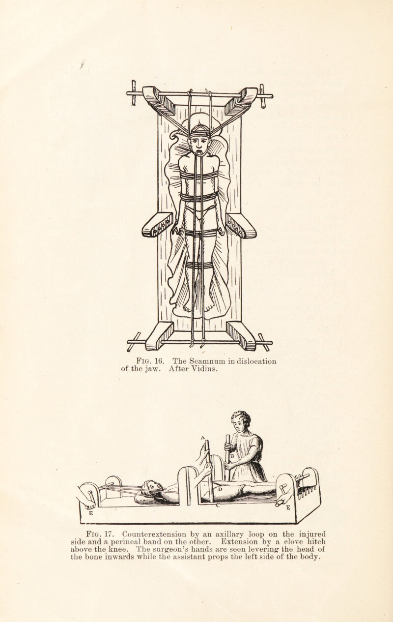 I / Fig. 16. The Scamnum in dislocation of the jaw. After Vidius. Fig. 17. Counterextension by an axillary loop on the injured side and a perineal band on the other. Extension by a clove hitch above the knee. The surgeon’s hands are seen levering the head of the bone inwards while the assistant props the left side of the body.