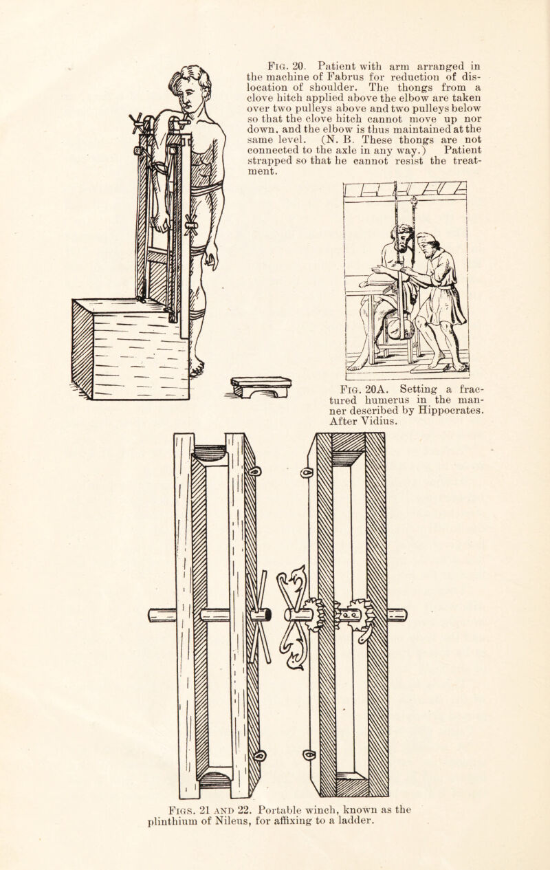 Fig. 20. Patient with arm arrang’ed in the machine of Fabrus for reduction of dis- location of shoulder. The thongs from a clove hitch applied above the elbow are taken over two pulleys above and two pulleys below so that the clove hitch cannot move up nor down, and the elbow is thus maintained at the same level. (N. B. These thongs are not connected to the axle in any way.) Patient strapped so that he cannot resist the treat- ment. Fig. 20A. Setting a frac- tured humerus in the man- ner described by Hippocrates. After Vidius. Figs. 21 and 22. Portable winch, known as the plinthium of Nileus, for affixing to a ladder.