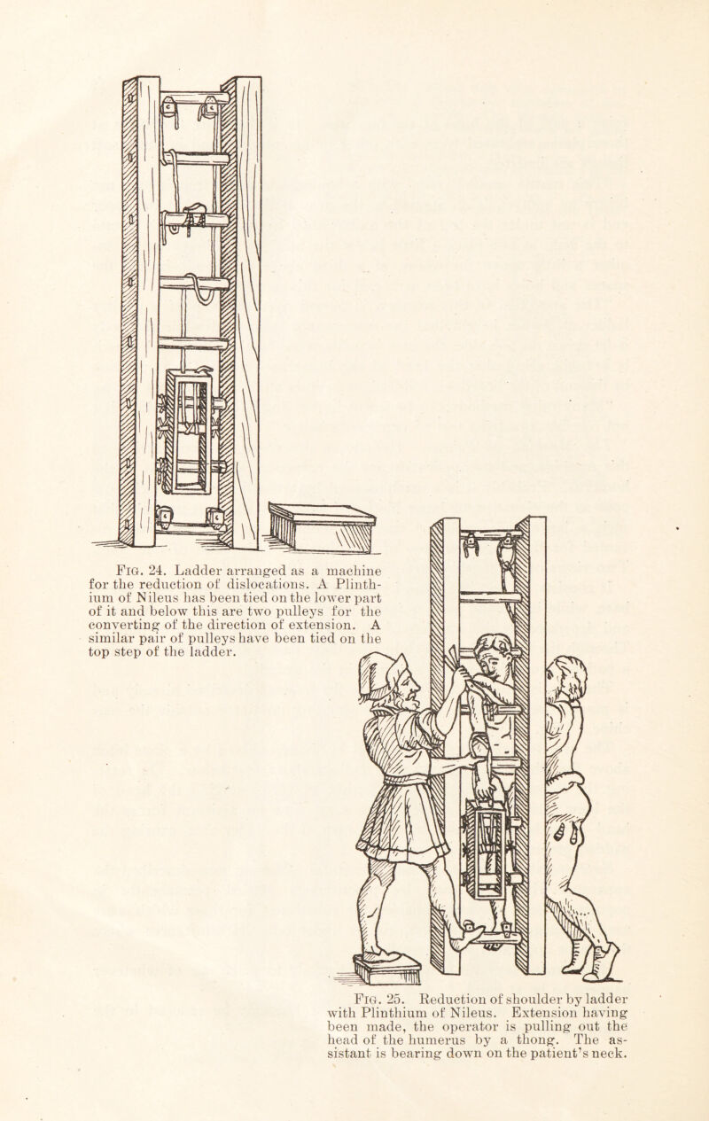 Fig. 24. Ladder arranged as a machine for the reduction of dislocations. A Plinth- inm of N ileus has been tied on the lower part of it and below this are two pulleys for the converting of the direction of extension. A similar pair of pulleys have been tied on the top step of the ladder. Fig. 25. Reduction of shoulder by ladder with Plinthium of Nileus. Extension having been made, the operator is pulling out the head of the humerus by a thong. The as- sistant is bearing down on the patient’s neck.