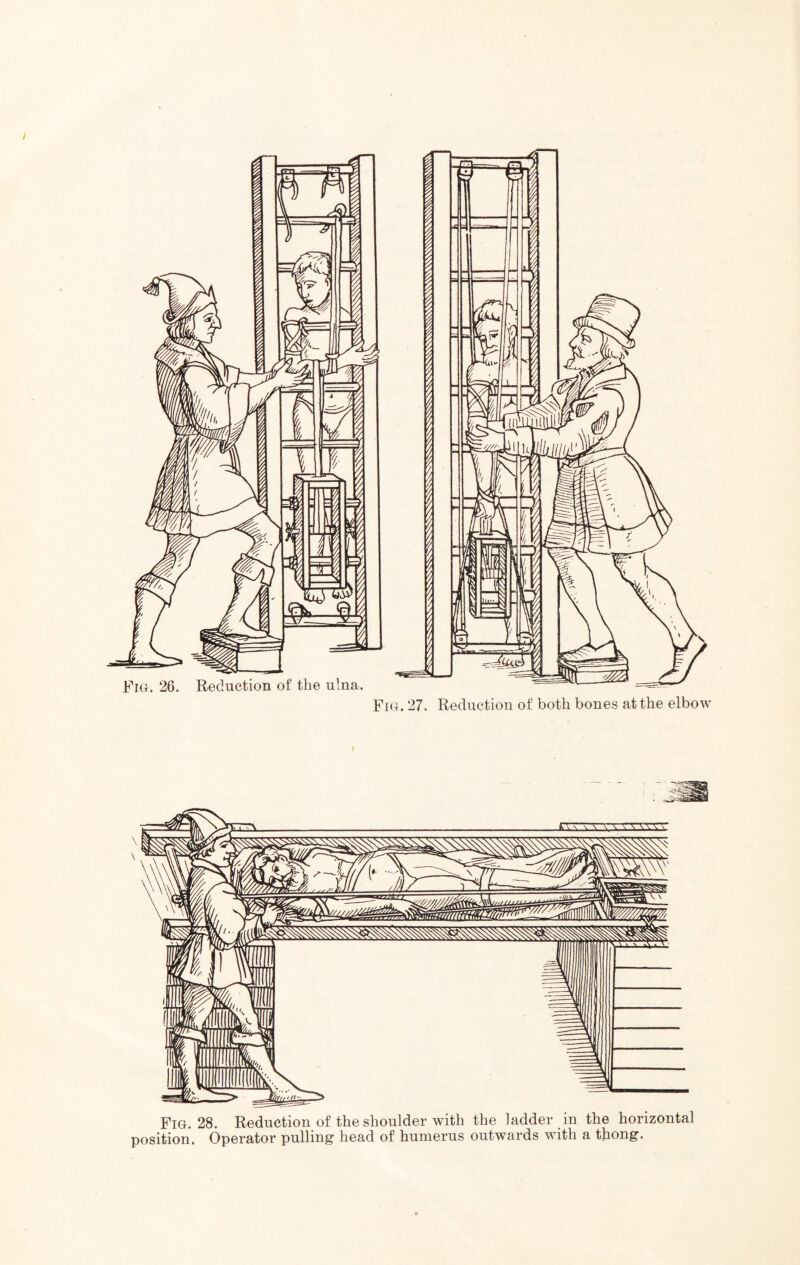 Fig. 28. Reduction of the shoulder with the ladder in the horizontal position. Operator pulling head of humerus outwards with a thong.