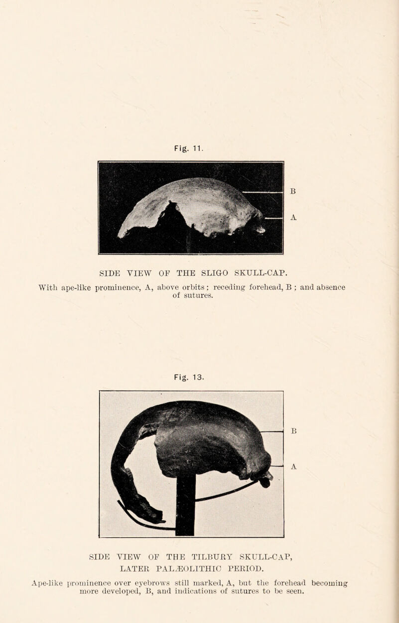 SIDE VIEW OF THE SLIGO SKULL-CAP. With ape-like prominence, A, above orbits : receding forehead, B ; and absence of sutures. Fig. 13. SIDE VIEW OF THE TILBUBY SKULL-CAP, LATEB PALAEOLITHIC PEIIIOD. .Ipe-like ]n’omiuence over eyebrows still marked, A, but the forehead becoming moi’e develoijed, B, and indications of sutures to be seen.