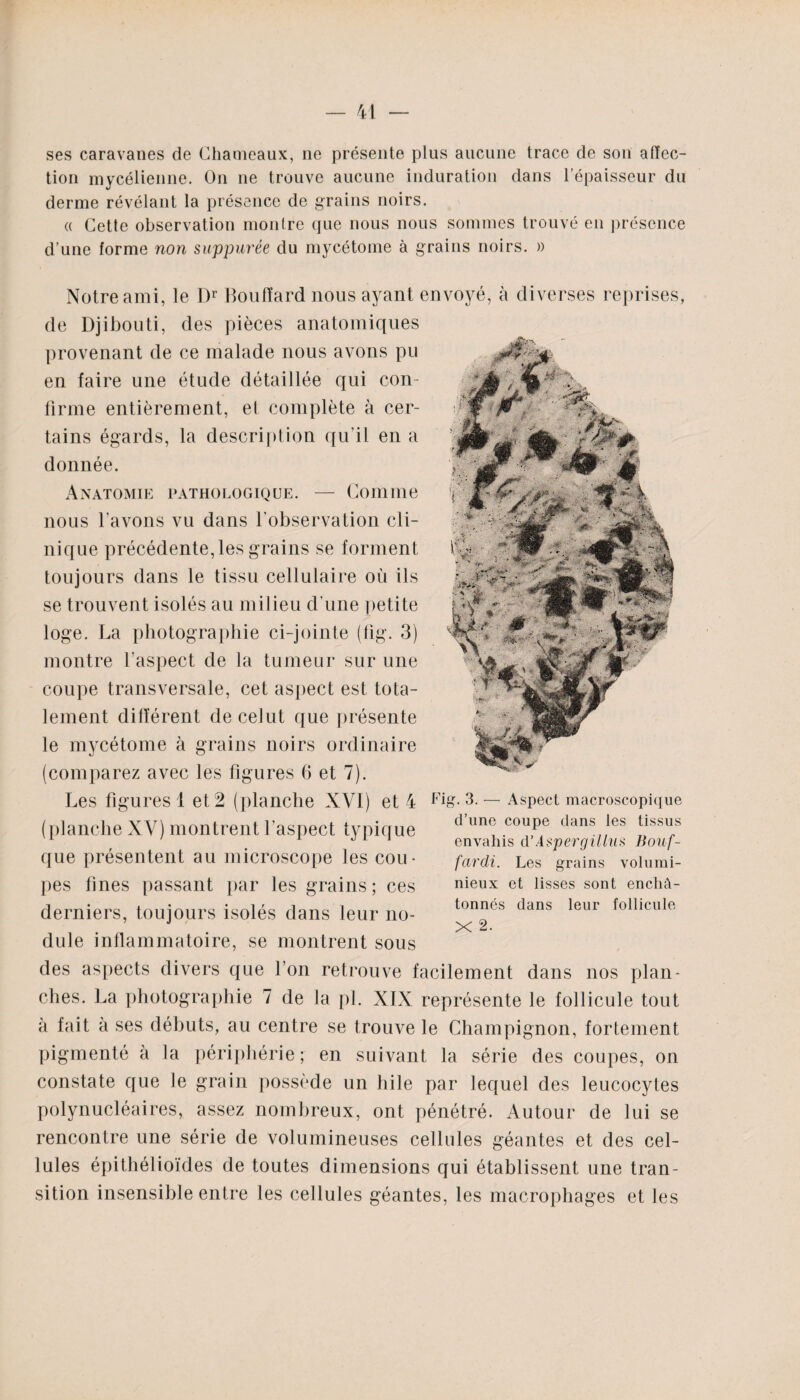 ses caravanes de Chameaux, ne présente plus aucune trace de son affec¬ tion mycélienne. On ne trouve aucune induration dans l’épaisseur du derme révélant la présence de grains noirs. « Cette observation montre que nous nous sommes trouvé en présence d’une forme non suppurée du mycétome à grains noirs. » Notre ami, le Dr Boufïard nous ayant envoyé, à diverses reprises, de Djibouti, des pièces anatomiques provenant de ce malade nous avons pu en faire une étude détaillée qui con¬ firme entièrement, et complète à cer¬ tains égards, la description qu’il en a donnée. Anatomie pathologique. — Comme nous l'avons vu dans l’observation cli¬ nique précédente, les grains se forment toujours dans le tissu cellulaire où ils se trouvent isolés au milieu d’une petite loge. La photographie ci-jointe (fig. 3) montre l’aspect de la tumeur sur une coupe transversale, cet aspect est tota¬ lement différent de celut que présente le mycétome à grains noirs ordinaire (comparez avec les figures 6 et 7). Les figures 1 et 2 (planche XVI) et 4 (planche XV) montrent l’aspect typique que présentent au microscope ies cou¬ pes fines passant par les grains; ces derniers, toujours isolés dans leur no¬ dule inflammatoire, se montrent sous des aspects divers que l’on retrouve facilement dans nos plan¬ ches. La photographie 7 de la pl. XIX représente le follicule tout à fait à ses débuts, au centre se trouve le Champignon, fortement pigmenté a la périphérie; en suivant la série des coupes, on constate que le grain possède un hile par lequel des leucocytes polynucléaires, assez nombreux, ont pénétré. Autour de lui se rencontre une série de volumineuses cellules géantes et des cel¬ lules épithélioïdes de toutes dimensions qui établissent une tran¬ sition insensible entre les cellules géantes, les macrophages et les Fig. 3. — Aspect macroscopique d’une coupe dans les tissus envahis d’Aspergillus Bouf- fardi. Les grains volumi- nieux et lisses sont enchû- tonncs dans leur follicule X 2.