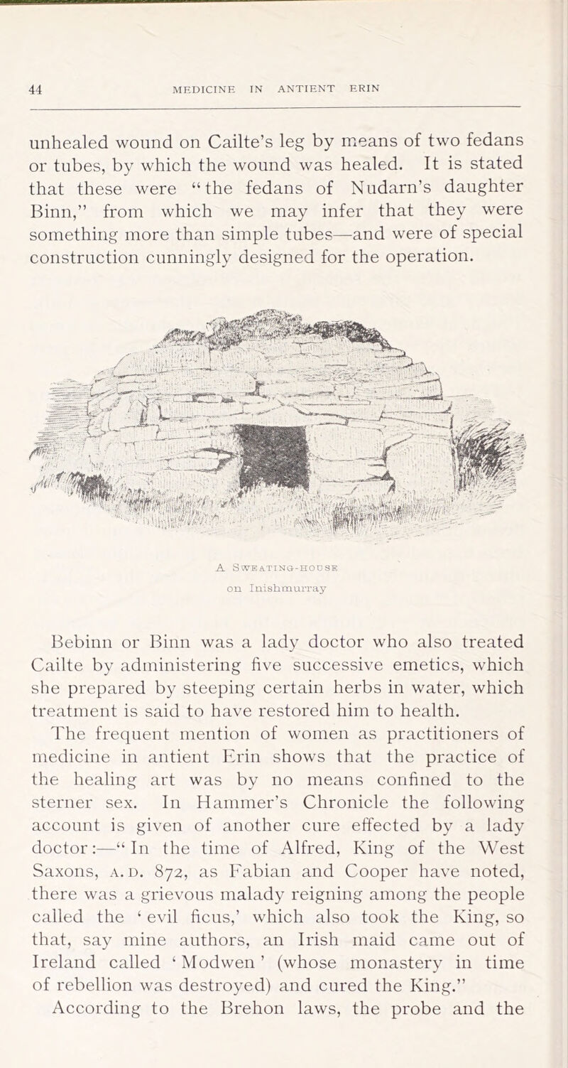 unhealed wound on Cailte’s leg by means of two fedans or tubes, by which the wound was healed. It is stated that these were “the fedans of Nudarn’s daughter Binn,” from which we may infer that they were something more than simple tubes—and were of special construction cunningly designed for the operation. A Sot'bating-hodse on luishmurray Bebinn or Binn was a lady doctor who also treated Cailte by administering five successive emetics, which she prepared by steeping certain herbs in water, which treatment is said to have restored him to health. The frequent mention of women as practitioners of medicine in antient Ifrin shows that the practice of the healing art was by no means confined to the sterner sex. In Hammer’s Chronicle the following account is given of another cure effected by a lady doctor;—“In the time of Alfred, King of the West Saxons, a. d. 872, as Fabian and Cooper have noted, there was a grievous malady reigning among the people called the ‘ evil ficus,’ which also took the King, so that, say mine authors, an Irish maid came out of Ireland called ‘ Mod wen ’ (whose monastery in time of rebellion was destroyed) and cured the King.’’ According to the Brehon laws, the probe and the