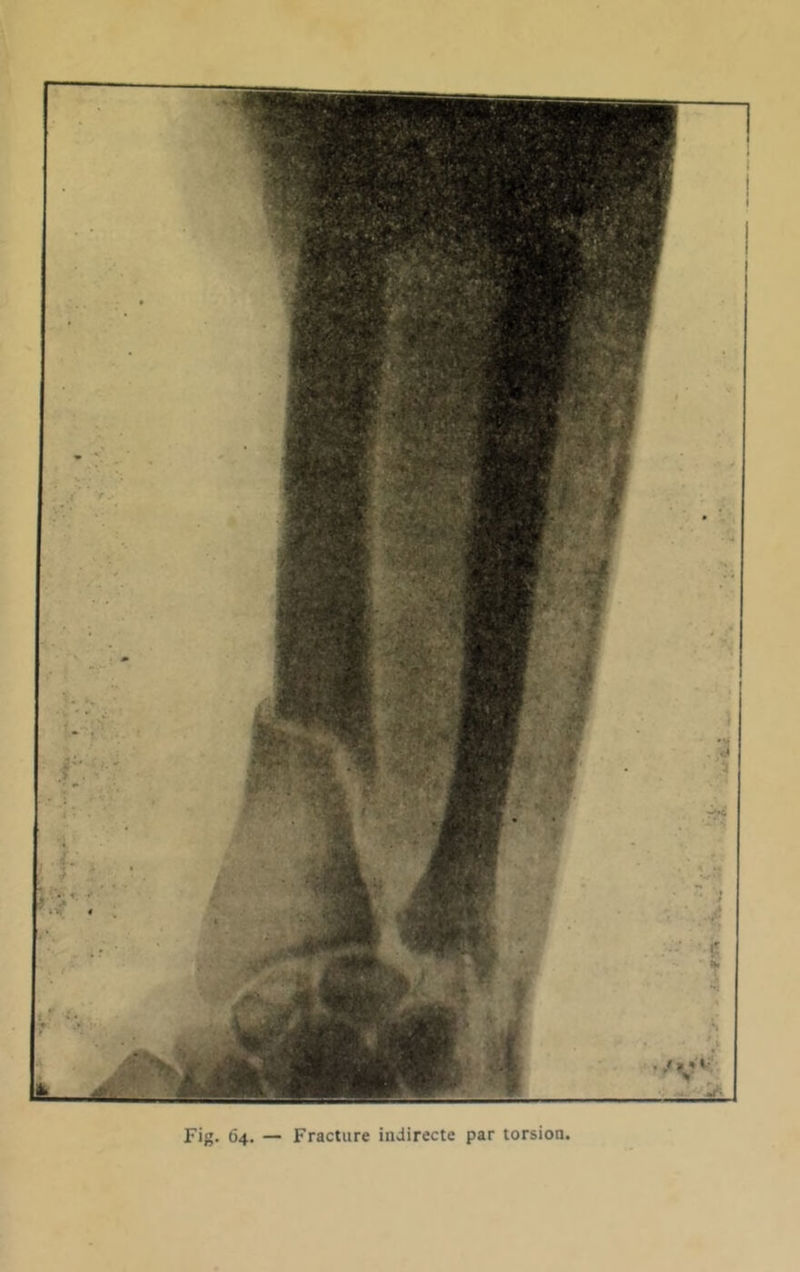 Fig. 64. — Fracture indirecte par torsion.