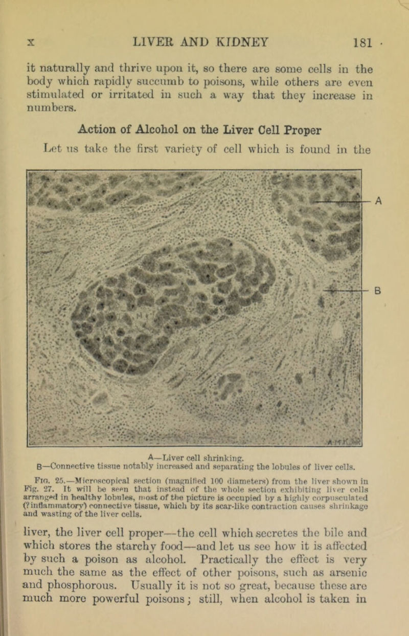 it natumlly and tlirive upon it, so there arc some cells in the body which rapidly succumb to poisons, while others are even stimulated or irritated in such a way that thej’ increase in numbers. Action of Alcohol on the Liver Cell Proper lict US take the first variety of cell which is found in the Fifi. 25.—Microscopical section (magnified 100 diameters) from the liver shown in Fifr. 27. It will be seen tliat instead of the whole section exhibiting li^er cells arranged in healthy lobules, most of ttio picture is occupied by a highly corpiisculatcd (?intlamnu»tory) connective tissue, which by its scar-like contraction causes shriukagu and wasting of the liver cells. liver, the liver cell proper—the cell which secretes the bile and which stores the starchy food—and let us sec how it is afi’ected by such a poison as alcohol. Practically the effect is very much the same as the effect of other poisons, such as arsenic and phosphorous. Usually it is not so great, because those are much more powerful poisons; still, when alcohol is taken in