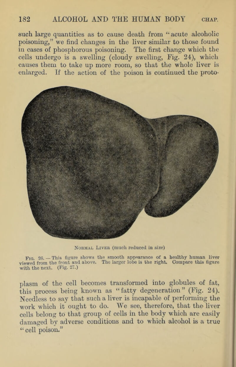 such large quantities as to cause death from ‘‘ acute alcoholic poisoning,” we find changes in the liver similar to those found in cases of phosphorous poisoning. The first change which the cells undergo is a swelling (cloudy swelling, Fig. 24), which causes them to take up more room, so that the whole liver is enlarged. If the action of the poison is continued the proto- Noumal Liver (much reduced in size) PiQ. 26. Tliis figure shows the smooth appearance of a healthy human liver viewed from the front and above. The larger lobe is the right. Compare this figure with the next. (Fig- 2-) plasm of the cell becomes transformed into globules of fat, this process being known as “fatty degeneration” (Fig. 24). Needless to say that such a liver is incapable of performing the work which it ought to do. We see, therefore, that the liver cells belong to that group of cells in the body which are easily damaged by adverse conditions and to which alcohol is a true “ cell poison.”