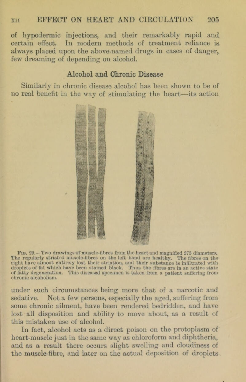of hypodermic injections, and their remarkably rapid and certain etfect. In modern methods of treatment reliance is. always placed upon the above-named drugs in cases of danger,, few dreaming of depending on alcohol. Alcohol and Chronic Disease Similarly in chronic disease alcohol has been shown to bo of no real benefit in the way of stimulating the heart—its action Fio. 2t>.—Two firawfnf?s of nmsclf-flbres from the heart ami magnified S75 diameterJi Tlie njgularly striated uiuscle-librcs on the left hand are healthy. The fibres on the right have almost entirely lost their slriation, and their subatance is infiitrate<i with droplets of fat which have been stained black. Thus the fibres are in an active .state of fatty degeneration. This diseased specimen is taken from a jiatient suQ'ering from chronic alcoholism. under such circumstances being more that of a narcotic and sedative. Not a few persons, especially the aged, suti'ering from some chronic ailment, have been rendered bedridden, and have lost all disposition and ability to move about, as a result of this mistitken use of alcohol. I In fact, alcohol acts as a direct poison on the protoplasm of j heart-muscle just in the same way as chloroform and diphtheria, I and as a result there occurs slight swelling and cloudiness of the muscle-fibre, and later on the actual deposition of droplets