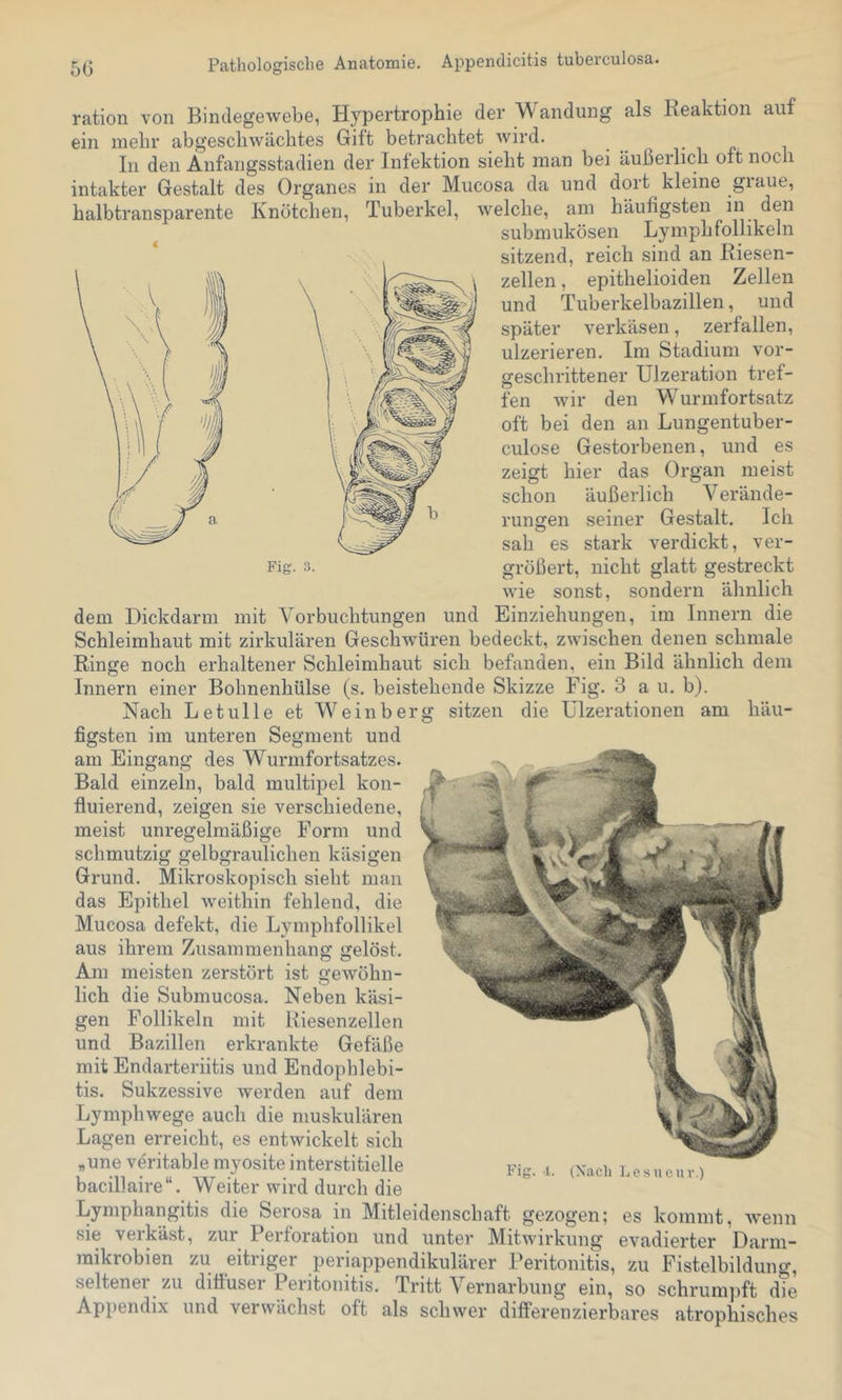 ration von Bindegewebe, Hypertrophie der andung als Keaktion auf ein mehr abgescliwächtes Gift betrachtet wird. In den Anfangsstadien der Infektion sieht inan bei äußerlich oft noch intakter Gestalt des Organes in der Mucosa da und dort kleine graue, halbtransparente Knötchen, Tuberkel, welche, am häufigsten in den submukösen Lymphfollikeln sitzend, reich sind an Riesen- zellen , epithelioiden Zellen und Tuberkelbazillen, und später verkäsen, zerfallen, ulzerieren. Im Stadium vor- geschrittener Uizeration tref- fen wir den Wurmfortsatz oft bei den an Lungentuber- culose Gestorbenen, und es zeigt hier das Organ meist schon äußerlich V erände- rungen seiner Gestalt. Ich sah es stark verdickt, ver- größert, nicht glatt gestreckt wie sonst, sondern ähnlich dem Dickdarm mit Yorbuchtungeii und Einziehungen, im Innern die Schleimhaut mit zirkulären Geschwüren bedeckt, zwischen denen schmale Ringe noch erhaltener Schleimhaut sich befanden, ein Bild ähnlich dem Innern einer Bohnenhülse (s. beistehende Skizze Fig. 3 a u. b). Nach Letulle et Weinberg sitzen die ülzerationen am häu- figsten im unteren Segment und am Eingang des Wurmfortsatzes. Bald einzeln, bald multipel kon- fluierend, zeigen sie verschiedene, meist unregelmäßige Form und schmutzig gelbgraulichen käsigen Grund. Mikroskopisch sieht man das Epithel weithin fehlend, die Mucosa defekt, die Lymphfollikel aus ihrem Zusammenhang gelöst. Am meisten zerstört ist gewöhn- lich die Submucosa. Neben käsi- gen Follikeln mit Riesenzellen und Bazillen erkrankte Gefäße mit Endarteriitis und Endophlebi- tis. Sukzessive werden auf dem Lymphwege auch die muskulären Lagen erreicht, es entwickelt sich „uneveritablemyositeinterstitielle pig.Lesucuv.) bacillaire“. Weiter wird durch die Lymphangitis die Serosa in Mitleidenschaft gezogen; es kommt, wenn sie verkäst, zur Perforation und unter Mitwirkung evadierter Darm- raikrobien zu eitriger periappendikulärer Peritonitis, zu Fistelbildung, seltener zu diöuser Peritonitis. Tritt Vernarbung ein, so schrumpft die Appendix und vei wächst oft als schwer differenzierbares atrophisches