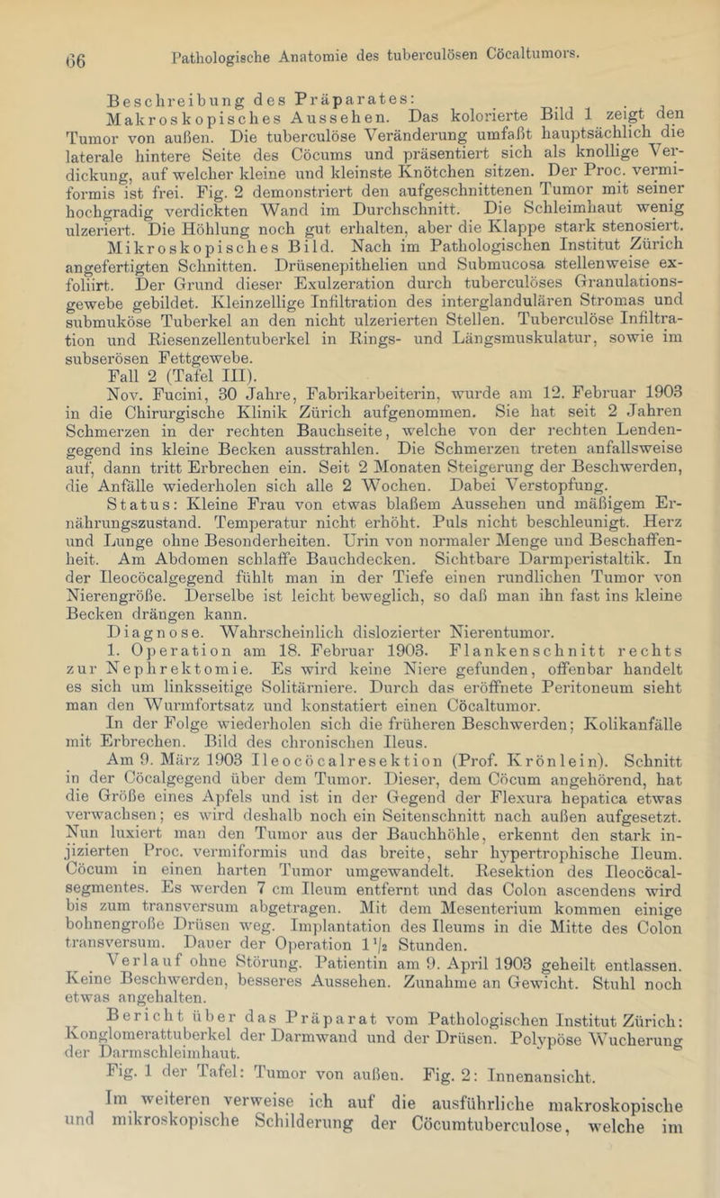 Beschreibung des Präparates: Makroskopisches Aussehen. Das kolorierte Bild 1 zeigt den Tumor von außen. Die tuberculöse Veränderung umfaßt hauptsächlich die laterale hintere Seite des Cöcums und präsentiert sich als knollige Ver- dickung, auf welcher kleine und kleinste Knötchen sitzen. Der Proc. vermi- formis ist frei. Fig. 2 demonstriert den aufgeschnittenen Tumor mit seiner hochgradig verdickten Wand im Durchschnitt. Die Schleimnaut wenig ulzeriert. Die Höhlung noch gut erhalten, aber die Klappe stark stenosiert. Mikroskopisches Bild. Nach im Pathologischen Institut Zürich angefertigten Schnitten. Drüsenepithelien und Submucosa stellenweise ex- foliirt. Der Grund dieser Exulzeration durch tuberculöses Granulations- gewebe gebildet. Kleinzellige Infiltration des interglandulären Stromas^ und submuköse Tuberkel an den nicht ulzerierten Stellen. Tuberculöse Inhltra- tion und Kiesenzellentuberkel in Rings- und Längsmuskulatur, sowie im subserösen Fettgewebe. Fall 2 (Tafel III). Nov. Fucini, 30 Jahre, Fabrikarbeiterin, wurde am 12. Februar 1903 in die Chirurgische Klinik Zürich aufgenommen. Sie hat seit 2 Jahren Schmerzen in der rechten Bauchseite, welche von der rechten Lenden- gegend ins kleine Becken ausstrahlen. Die Schmerzen treten anfallsweise auf, dann tritt Erbrechen ein. Seit 2 Monaten Steigerung der Beschwerden, die Anfälle wiederholen sich alle 2 Wochen. Dabei Verstopfung. Status: Kleine Frau von etwas blaßem Aussehen und mäßigem Er- nährungszustand. Temperatur nicht erhöht. Puls nicht beschleunigt. Herz und Lunge ohne Besonderheiten. Urin von normaler Menge und Beschaffen- heit. Am Abdomen schlaffe Bauchdecken. Sichtbare Darmperistaltik. In der Ileocöcalgegend fühlt man in der Tiefe einen rundlichen Tumor von Nierengröße. jDerselbe ist leicht beweglich, so daß man ihn fast ins kleine Becken drängen kann. Diagnose. Wahrscheinlich dislozierter Nierentumor. 1. Operation am 18. Februar 1903. Flankenschnitt rechts zur Nephrektomie. Es wird keine Niere gefunden, offenbar handelt es sich um linksseitige Solitärniere. Durch das eröffnete Peritoneum sieht man den Wurmfortsatz und konstatiert einen Cöcaltumor. In der Folge wiederholen sich die früheren Beschwerden; Kolikanfälle mit Erbrechen. Bild des chronischen Ileus. Am 9. März 1903 Ileocöcalresektion (Prof. Krönlein). Schnitt in der Cöcalgegend über dem Tumor. Dieser, dem Cöcum angehörend, hat die Größe eines Apfels und ist in der Gegend der Flexura hepatica etwas verwachsen; es wird deshalb noch ein Seitenschnitt nach außen aufgesetzt. Nun luxiert man den Tumor aus der Bauchhöhle, erkennt den stark in- jizierten Proc. vermiformis und das breite, sehr h^^pertrophische Ileum. Cöcum in einen harten Tumor umgewandelt. Resektion des Ileocöcal- segmentes. Es werden 7 cm Ileum entfernt und das Colon ascendens wird bis zum transversum abgetragen. Mit dem Mesenterium kommen einige bohnengroße Drüsen weg. Implantation des Ileums in die Mitte des Colon transversum. Dauer der Operation 1^2 Stunden. Verlauf ohne Störung. Patientin am 9. April 1903 geheilt entlassen. Keine Beschwerden, besseres Aussehen. Zunahme an Gewicht. Stuhl noch etwas an geh alten. Bericht über das Präparat vom Pathologischen Institut Zürich: Konglomeiattubei kel der Darmwand und der Drüsen. Pclvpöse Wucheruno der Darmschleimhaut. “ Fig. 1 der Tafel: Tumor von außen. Fig. 2: Innenansicht. Im weiteien verweise ich auf die ausführliche makroskopische und mikroskopische Schilderung der Cöcumtuberculose, welche im