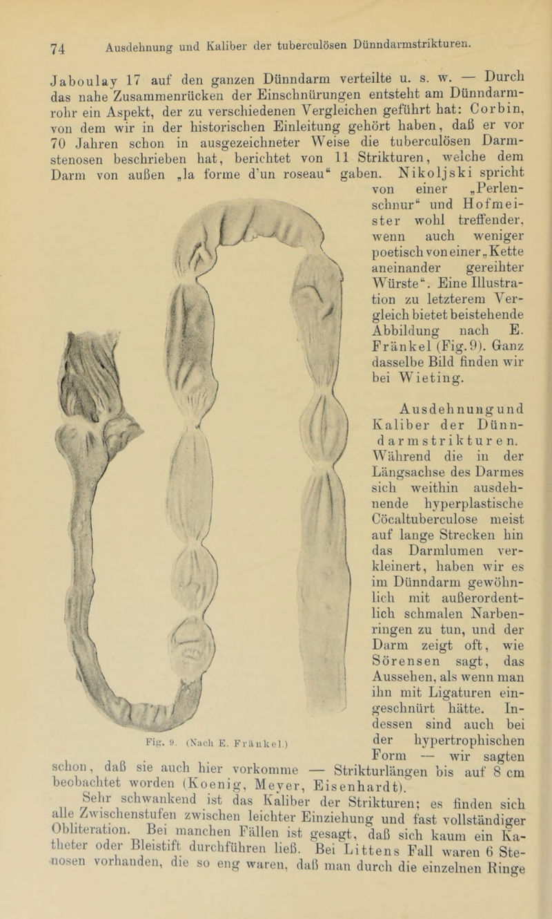 Ausdehnung und Kaliber der tuberculösen Dünndarmstrikturen. Jaboulay 17 auf den ganzen Dünndarm verteilte u. s. w. Durch das nahe Zusammenrücken der Einschnürungen entsteht am Dünndarm- rohr ein Aspekt, der zu verschiedenen Vergleichen geführt hat: Cor bin, von dem wir in der historischen Einleitung gehört haben, daß er vor 70 Jahren schon in ausgezeichneter Weise die tuberculösen Darm- stenosen beschrieben hat, berichtet von 11 Strikturen, welche dem Darm von außen „la forme d’un roseau“ gaben. Nikoljski spricht von einer „Perlen- schnur“ und Hofmei- ster wohl treffender, wenn auch weniger poetisch von einer „ Kette aneinander gereihter Würste“. Eine Illustra- tion zu letzterem Ver- gleich bietet beistehende Abbildung nach E. Frankel (Fig.9). Ganz dasselbe Bild finden wir bei es gewöhn- W ieting. Ausdeh nung und Kaliber der Dünn- darmstrikturen. Während die in der Längsachse des Darmes sich weithin ausdeh- nende hyperplastische Cöcaltuberculose meist auf lange Strecken hin das Darmlumen ver- kleinert, haben wir im Dünndarm lieh mit außerordent lieh schmalen Narben- ringen zu tun, und der Darm zeigt oft, wie Sörensen sagt, das Aussehen, als wenn man ihn mit Ligaturen ein- geschnürt hätte. In- dessen sind auch bei der hypertrophischen Form — wir sagten — Strikturlängen bis auf 8 cm '31, Eisenhardt). . jsf das Kaliber der Strikturen; es finden sich alle Zwischenstufen zwischen leichter Einziehung und fast vollständiger Dbhteration. Bei manchen Fällen ist sesaert. daß sich kaum ein Ka- ens Fall waren 6 Ste- waren, daß man durch die einzelnen Hiiiffe Fiff. 9. (Nach E. Fränkol.) schon daß sie auch hier vorkoninie beobachtet worden (Koenig, Mever, Sehr schwankend o , j -m • •1' 1 gesagt, daß sich kaum theter oder Bleistift durchführen ließ. Bei Litt nosen vorhanden, die so eng