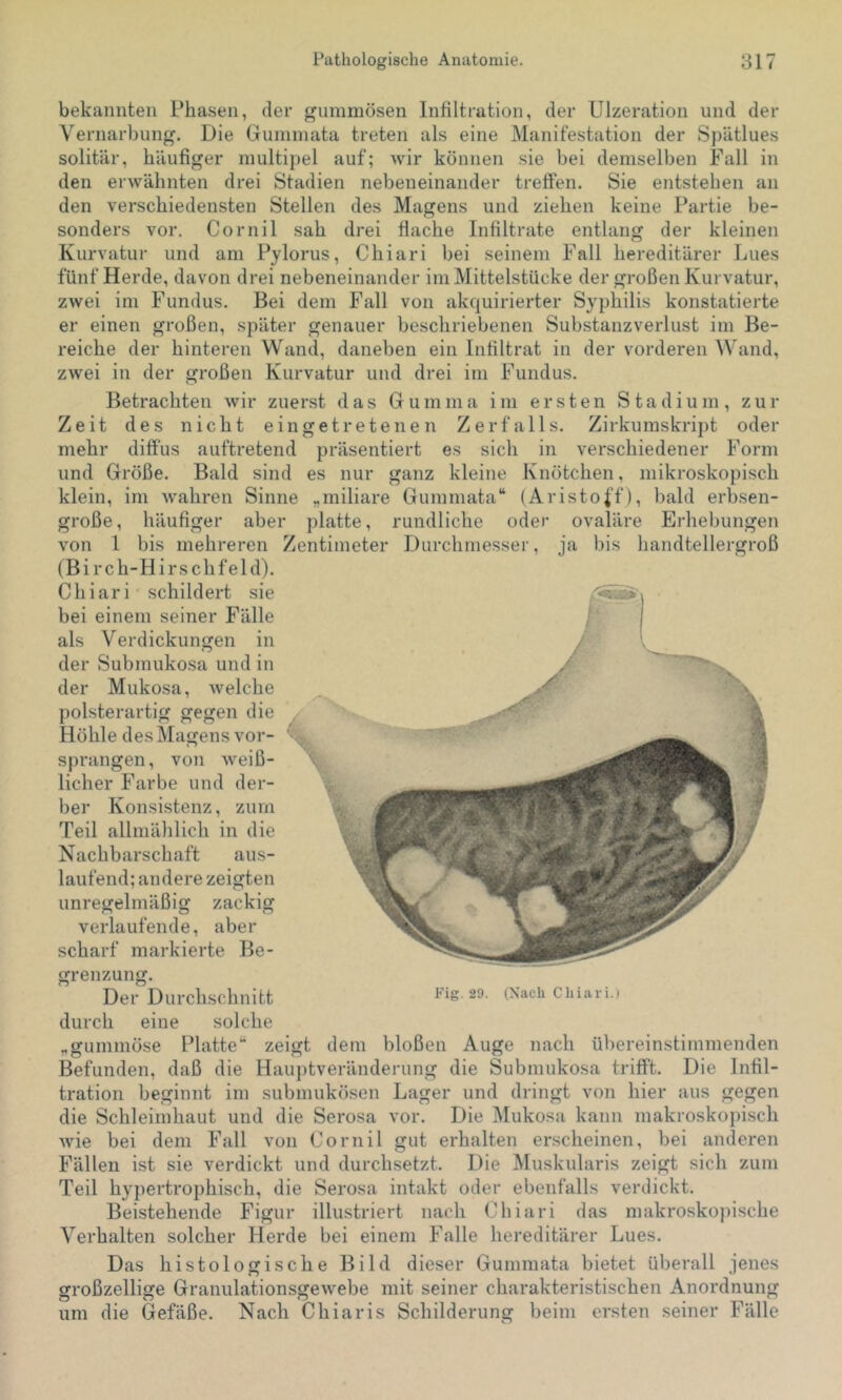 bekannten Phasen, der gummösen Infiltration, der Ulzeration und der Vernarbung. Die Gummata treten als eine Manifestation der Spätlues solitär, häufiger multipel auf; wir können sie bei demselben Fall in den erwähnten drei Stadien nebeneinander treffen. Sie entstehen an den verschiedensten Stellen des Magens und ziehen keine Partie be- sonders vor. Cornil sah drei flache Infiltrate entlang der kleinen Kurvatur und am Pylorus, Chiari bei seinem Fall hereditärer Lues fünf Herde, davon drei nebeneinander im Mittelstücke der großen Kurvatur, zwei im Fundus. Bei dem Fall von akquirierter Syphilis konstatierte er einen großen, später genauer beschriebenen Substanzverlust im Be- reiche der hinteren Wand, daneben ein Infiltrat in der vorderen Wand, zwei in der großen Kurvatur und drei im Fundus. Erhebungen handtellergroß Betrachten wir zuerst das Gumma im ersten Stadium, zur Zeit des nicht eingetretenen Zerfalls. Zirkumskript oder mehr diffus auftretend präsentiert es sich in verschiedener Form und Größe. Bald sind es nur ganz kleine Knötchen, mikroskopisch klein, im wahren Sinne „miliare Gummata“ (Aristo|'f), bald erbsen- große, häufiger aber platte, rundliche oder ovaläre von 1 bis mehreren Zentimeter Durchmesser, ja bis (B i r c h- H i r s c h f e 1 d). Chiari schildert sie bei einem seiner Fälle als Verdickungen in der Submukosa und in der Mukosa, welche polsterartig gegen die Höhle des Magens vor- '■ sprangen, von weiß- licher Farbe und der- ber Konsistenz, zum Teil allmählich in die Nachbarschaft aus- laufend; andere zeigten unregelmäßig zackig verlaufende, aber scharf markierte Be- grenzung. Der Durchschnitt Fig. 29. (Nach Chiari.) durch eine solche „gummöse Platte“ zeigt dem bloßen Auge nach übereinstimmenden Befunden, daß die Hauptveränderung die Submukosa trifft. Die Infil- tration beginnt im submukösen Lager und dringt von hier aus gegen die Schleimhaut und die Serosa vor. Die Mukosa kann makroskopisch wie bei dem Fall von Cornil gut erhalten erscheinen, bei anderen Fällen ist sie verdickt und durchsetzt. Die Muskularis zeigt sich zum Teil hypertrophisch, die Serosa intakt oder ebenfalls verdickt. Beistehende Figur illustriert nach Chiari das makroskopische Verhalten solcher Herde bei einem Falle hereditärer Lues. Das histologische Bild dieser Gummata bietet überall jenes großzellige Granulationsgewebe mit seiner charakteristischen Anordnung um die Gefäße. Nach Chiaris Schilderung beim ersten seiner Fälle