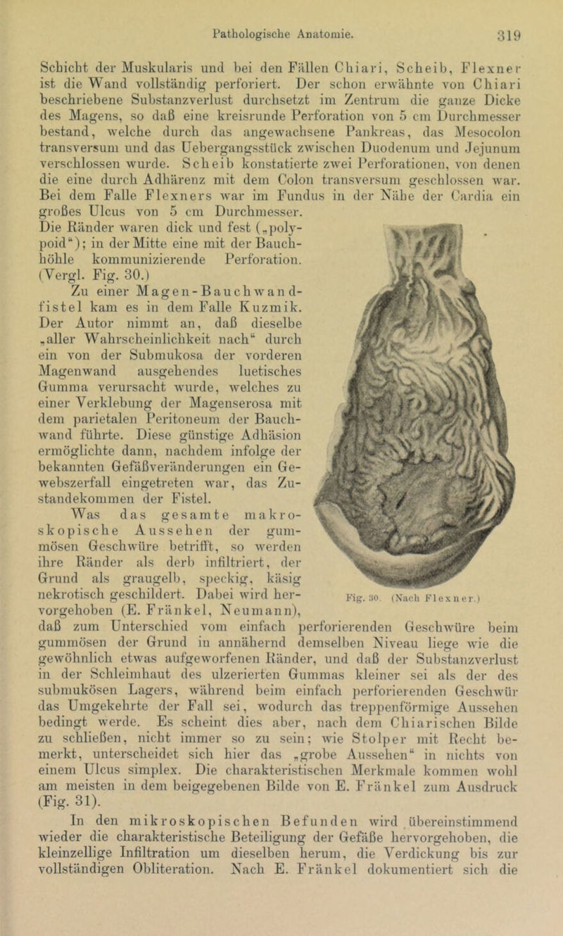 Schiebt der Muskularis und bei den Fällen Chiari, Scheib, Flexner ist die Wand vollständig perforiert. Der schon erwähnte von Chiari beschriebene Substanzverlust durchsetzt im Zentrum die ganze Dicke des Magens, so daß eine kreisrunde Perforation von 5 cm Durchmesser bestand, welche durch das angewachsene Pankreas, das Mesocolon transversum und das Uebergangsstück zwischen Duodenum und .Jejunum verschlossen wurde. Scheib konstatierte zwei Perforationen, von denen die eine durch Adhärenz mit dem Colon transversum geschlossen war. Bei dem Falle Flexners war im Fundus in der Nähe der Cardia ein großes Ulcus von 5 cm Durchmesser. Die Ränder waren dick und fest („pol}- poid“); in der Mitte eine mit der Bauch- höhle kommunizierende Perforation. (Vergl. Fig. 30.) Zu einer Magen-Bauchwan d- fistel kam es in dem Falle Kuzmik. Der Autor nimmt an, daß dieselbe ,aller Wahrscheinlichkeit nach“ durch ein von der Submukosa der vorderen Magenwand ausgehendes luetisches Gumma verursacht wurde, welches zu einer Verklebung der Magenserosa mit dem j)arietalen Peritoneum der Bauch- wand führte. Diese günstige Adhäsion ermöglichte dann, nachdem infolge der bekannten Gefäßveränderungen ein Ge- webszerfall eingetreten war, das Zu- standekommen der Fistel. Was das gesamte m a k r o- skopische Aussehen der gum- mösen Geschwüre betrifft, so werden ihre Ränder als derb infiltriert, der Grund als graugelb, speckig, käsig nekrotisch geschildert. Dabei wird her- vorgehoben (E. Fränkel, Neu mann), daß zum Unterschied vom einfach perforierenden Gesch^vüre beim gummösen der Grund in annähernd demselben Niveau liege Avie die gewöhnlich etwas aufgeworfenen Ränder, und daß der Substanzverlust in der Schleimhaut des ulzerierten Gummas kleiner sei als der des submukösen Lagers, während beim einfach perforierenden Geschwür das Umgekehrte der Fall sei, wodurch das treppenförmige Au.ssehen bedingt werde. Es scheint dies aber, nach dem Chi arischen Bilde zu schließen, nicht immer so zu sein; wie Stolper mit Recht be- merkt, unterscheidet sich hier das „grobe Aussehen“ in nichts von einem Ulcus simplex. Die charakteristischen Merkmale kommen wohl am meisten in dem beigegebenen Bilde von E. Fränkel zum Ausdruck (Fig. 31). Fig.‘JO. (Nacli Fl ex n er.) In den mikroskopischen Befunden wird .übereinstimmend Avieder die charakteristische Beteiligung der Gefäße hervorgehoben, die kleinzellige Infiltration um dieselben herum, die Verdickung bis zur vollständigen Obliteration. Nach E. Fränkel dokumentiert sich die