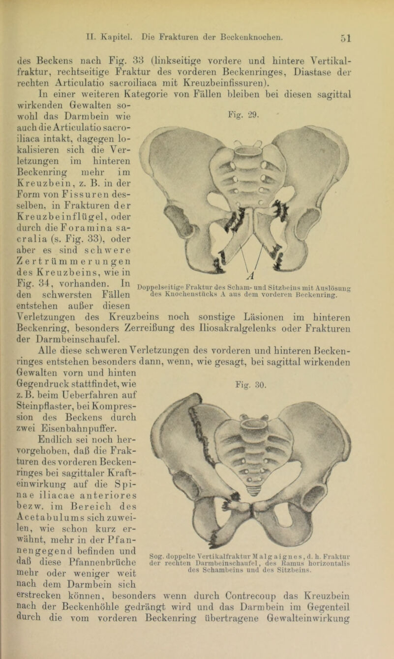 Fig. 29. Doppelseitige P’raktur des Scham- und Sitzbeins mit .Auslösung des Knocheiistilcks aus dem vorderen Beckenring. noch des Beckens nach Fig. 33 (linkseitige vordere und hintere Vertikal- fraktur, rechtseitige Fraktur des vorderen Beckenringes, Diastase der rechten Articulatio sacroiliaca mit Kreuzbeinfissuren). In einer weiteren Kategorie von Fällen lileiben bei diesen sagittal wirkenden Gewalten so- wohl das Darmbein wie auch die Articulatio sacro- iliaca intakt, dagegen lo- kalisieren sich die Ver- letzungen im hinteren Beckenring mehr im Kreuzbein, z. B. in der Form von Fissuren des- selben, in Frakturen der Kreuzbeinflügel, oder durch die Fora in in a sa- cralia (s. Fig. 33), oder aber es sind schwere Zertrümmerungen des Kreuzbeins, wie in Fig. 34, vorhanden. In den schwersten Fällen entstehen außer diesen Verletzungen des Kreuzbeins Beckenring, besonders der Darmbeinschaufel. Alle diese schweren Verletzungen des vorderen und hinteren Becken- ringes entstehen besonders dann, wenn, wie gesagt, bei sagittal wirkenden Gewalten vorn und hinten Gegendruck stattfindet, wde Fig. 30. z. B. beim Ueberfahren auf Steinpflaster, bei Kompres- sion des Beckens durch zwei Eisenbahnpuffer. Endlich sei noch her- vorgehoben, daß die Frak- turen des vorderen Becken- ringes bei sagittaler Kraft- einwirkung auf die Spi- nae iliacae anteriores bezw. im Bereich des Acetabulums sich zuwei- len, wie schon kurz er- wähnt, mehr in der Pfan- nengegend befinden und daß diese Pfannenbrüche mehr oder weniger weit nach dem Darmbein sich erstrecken können, besonders wenn durch Contrecoup das nach der Beckenhöhle gedrängt wird und das Darmbein Zerreißung sonstige des Iliosakralgelenks Läsionen im hinteren oder Frakturen Sog. doppelte Vertikalfraktin- M al g ai gne s, d. h. Fraktur der rechten Darmbeinschaufel, des Ramus horizontalis des Schambeins und des Sitzbeins. durch die vom vorderen Beckenring übertragene Kreuzbein Gegenteil Ge waltein Wirkung ini