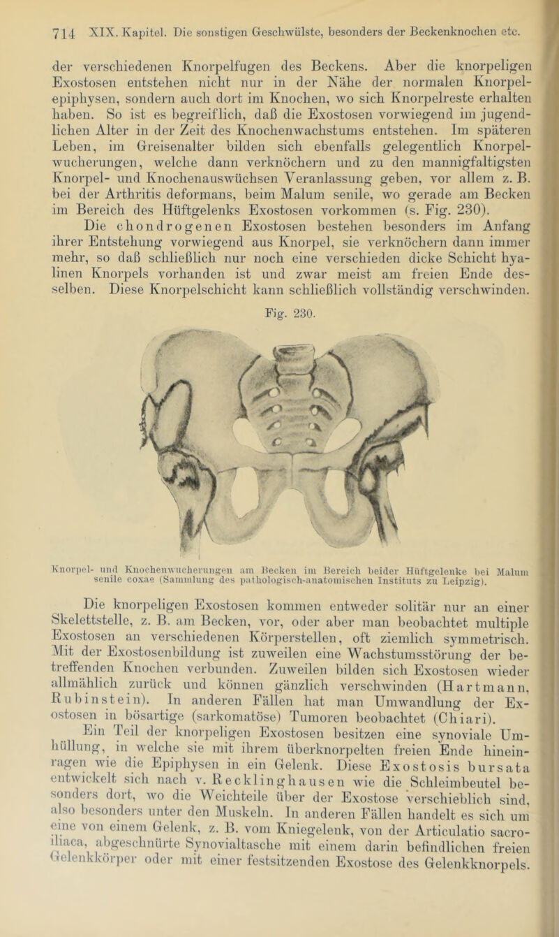 der verschiedenen Knorpelfugen des Beckens. Aber die knorpeligen Exostosen entstehen nicht nur in der Nähe der normalen Knorpel- epiphysen, sondern auch dort im Knochen, wo sich Knorpelreste erhalten haben. So ist es begreiflich, daß die Exostosen vorwiegend im jugend- lichen Alter in der Zeit des Knochenwachstums entstehen. Im späteren Leben, im Greisenalter bilden sich ebenfalls gelegentlich Knorpel- wucherungen, welche dann verknöchern und zu den mannigfaltigsten Knorpel- und Knochenauswüchsen Veranlassung geben, vor allem z. B. bei der Arthritis deformans, beim Malum senile, wo gerade am Becken im Bereich des Hüftgelenks Exostosen Vorkommen (s. Fig. 230). Die c h o n d r o g e n e n Exostosen bestehen besonders im Anfang ihrer Entstehung vorwiegend aus Knorpel, sie verknöchern dann immer mehr, so daß schließlich nur noch eine verschieden dicke Schicht hya- linen Knorpels vorhanden ist und zwar meist am freien Ende des- selben. Diese Knorpelschicht kann schließlich vollständig verschwinden. Fig. 230. Knorpel- uiul Knochenwuchernngeu am necken im Bereich Beider Hüftgelenke bei Malnm senile co.Kae (Sammlung des pathologisch-anatomischen Instituts zu Leipzig). Die knorpeligen Exostosen kommen entweder solitär nur an einer Skelettstelle, z. B. am Becken, vor, oder aber man beobachtet multiple Exostosen an verschiedenen Körperstellen, oft ziemlich symmetrisch. Mit der Exostosenbildung ist zuweilen eine Wachstumsstörung der be- treffenden Knochen verbunden. Zinveilen bilden sich Exostosen wieder allmählich zurück und können gänzlich verschAvinden (Hartmann, R ul) inst ein). In anderen Fällen hat man Umwandlung der Ex- ostosen in bösartige (sarkomatöse) Tumoren beoliachtet (Chiari). Ein Teil der knorpeligen Exostosen besitzen eine synoviale. Um- hüllung, in Avelche sie mit ihrem überknorpelten freien Ende hinein- ragen wie die Epiphysen in ein Gelenk. Diese Exostosis bursata entwickelt sich nach a’. Recklinghausen Avie die Schleimbeutel be- sonders dort, Avo die Weichteile über der Exostose A^erschieblich sind, also besonders unter den Muskeln, ln anderen Fällen handelt es sich um eine von einem Gelenk, z. B. vom Kniegelenk, von der Articulatio sacro- ihaca, abgeschnürte Synovialtasche mit einem darin befindlichen freien <ielenkköri)er oder mit einer festsitzenden Exostose des Gelenkknorpels.