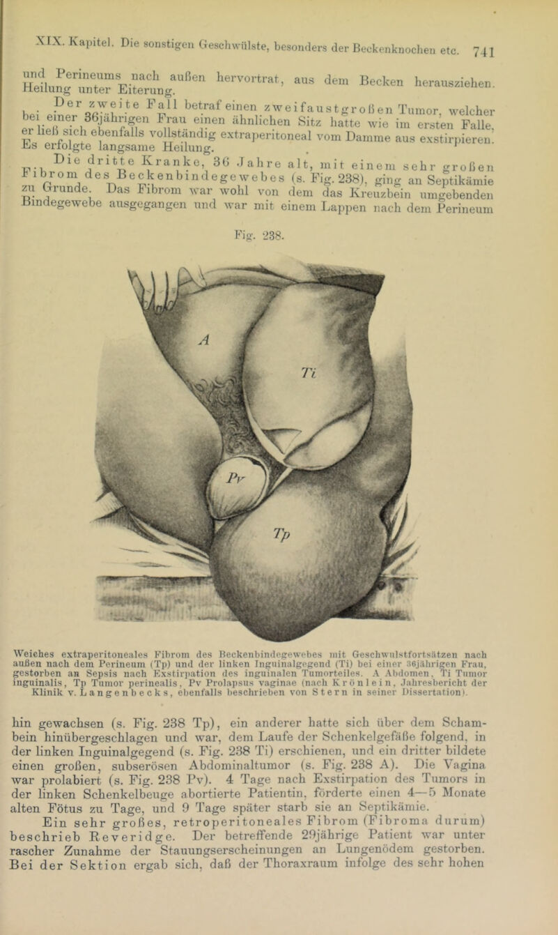 Heirrirr Ei?:™.““' herausziehen. De bei einer er ließ sicli ebenfalls vollständig extrap Es erfolgte langsame Heilung. Die dritte Kranke, 3G Jahre alt, mit einem sehr großen hibrom des Becken bindege web es (s. Fig. 238), ging au Septikämie zii ^rwnde Das Fibrom war wohl von dem das Kreuzbein umgebenden Bindegewebe ausgegangen und war mit einem Lappen nach dem Perineum Fig. 238. Weiches extraperitoneales Fibrom des Beckenbindegewebes mit Geschwulstfortsätzen nach außen nach dem Perineum (Tp) und der linken Inguinalgegend (Ti) bei einer 36jälirigen Frau, gestorben an Sepsis nach Exstirjjation des inguinalen Tumorteiles. A .\bdomen, Ti Tumor inguinalis, Tp Tumor perinealis, Pv Prolapsus vaginae (nach Krönlein, Jahresbericht der Klinik v. Langenbecks, ebenfalls beschrieben von Stern in seiner Dissertation). hin gewachsen (s. Fig. 238 Tp), ein anderer hatte sich über dem Scham- bein hinübergeschlagen und war, dem Laufe der Schenkelgefäße folgend, in der linken Inguinalgegend (s. Fig. 238 Ti) erschienen, und ein dritter bildete einen großen, subserösen Abdominaltumor (s. Fig. 238 A). Die Vagina war prolabiert (s. Fig. 238 Pv). 4 Tage nach Exstirpation des Tumors in der linken Schenkelbeuge abortierte Patientin, förderte einen 4—5 Monate alten Fötus zu Tage, und 9 Tage später starb sie an Septikämie. Ein sehr großes, retroperitoneales Fibrom (Fibroma durum) beschrieb Eeveridge. Der betreffende 29jährige Patient war unter rascher Zunahme der Stauungserscheinungen an Lungenödem gestorben. Bei der Sektion ergab sich, daß der Thoraxraum infolge des sehr hohen