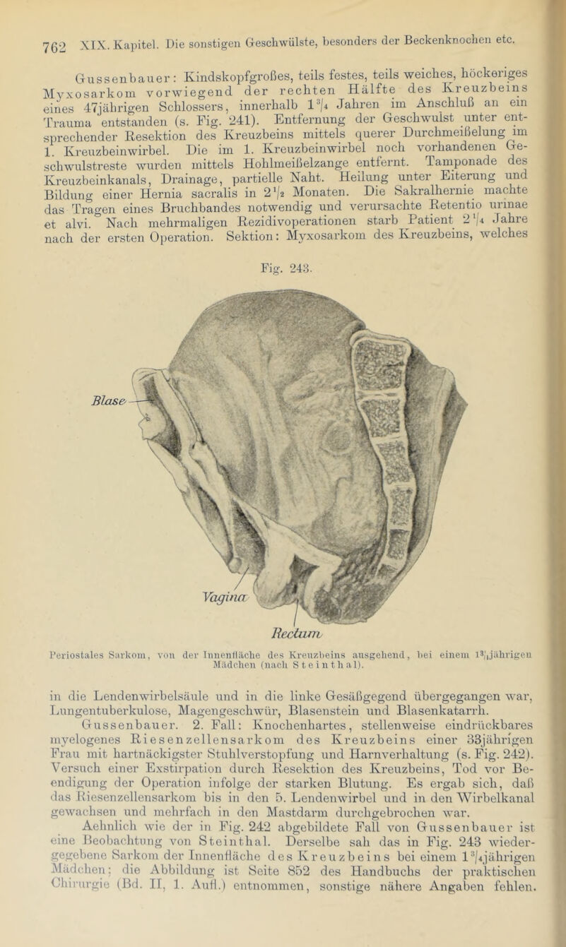 Gusseubauer: Kindskopfgroßes, teils festes, teils weiches, höckeriges MyxoSarkom vorwiegend der rechten Hälfte des Kreuzbeins eines 47jäbrigen Schlossers, innerhalb 1im An.^chbiß an ein Trauma entstanden (s. Fig. 241). Entfernung der Geschwulst unter ent- sprechender Resektion des Kreuzbeins mittels querer Durchmeißelung im 1. Kreuzbeinwirbel. Die im 1. Kreuzbeinwirbel noch vorhandenen Ge- schwulstreste wurden mittels Hohlmeißelzange entfernt. Tamponade des Kreuzbeinkanals, Drainage, partielle Naht. Heilung unter Eiterung und Bildung einer Hernia sacralis in 2‘/2 Monaten. Die Sakralhernie machte das Tragen eines Bruchbandes notwendig und verursachte Ketentio urinae et alvi. Nach mehrmaligen Kezidivoperationen starb Patient 2‘[4 Jahre nach der ersten Operation. Sektion: Myxosarkom des Kreuzbeins, welches Fig. 248. Bectum Periostales Sarkom, von der Innentlilclie des Kreuzbeins ansgehend, bei einem i®i'ijiihrigeu Mildchen (uacli S t e i n t h a 1). in die Lendenwirbelsäule und in die linke Gesäßgegend übergegangen war, lAingentuberkulose, Magengeschwür, Blasen stein und Blasenkatarrh. Gussenbauer. 2. Fall: Knochenhartes, stellenweise eindrückbares myelogenes Riesenzellensarkom des Kreuzbeins einer ßSjährigen Frau mit hartnäckigster Stuhlverstopfung und Harnverhaltung (s. Fig. 242). Versuch einer Exstirpation durch Resektion des Kreuzbeins, Tod vor Be- endigung der Operation infolge der starken Blutung. Es ergab sich, daß das Riesenzellensarkom bis in den 5. Lendenwirbel und in den Wirbelkanal gewachsen und mehrfach in den Mastdarm durchgebrochen war. Aehnlich wie der in Fig. 242 abgebildete Fall von Gussenbauer ist eine Beobachtung von Steinthal. Derselbe sah das in Fig. 243 wieder- gegebene Sarkom der Innenlläche des Kreuzbeins bei einem l*|4jährigen Mädchen; die Abbildung ist Seite 852 des Handbuchs der praktischen Chii-urgie (Bd. II, 1. Aull.) entnommen, sonstige nähere Angaben fehlen.