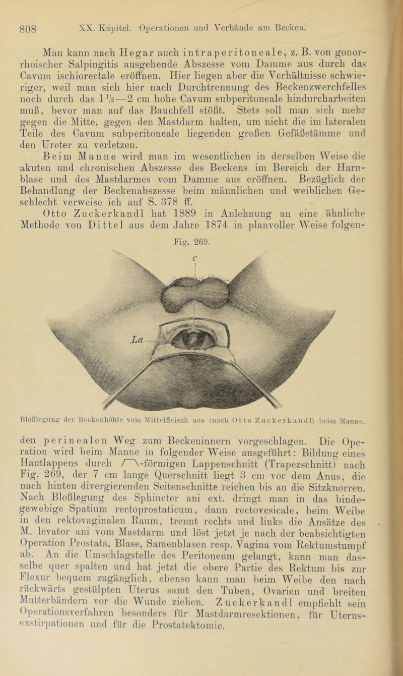 Mau kann nach Hegar auch intraperitoneale, z. B. von gonor- rhoischer Salpingitis ausgehende Abszesse vom Damme ans durch das Cavuni ischiorectale eröffnen. Hier liegen aber die Verhältnisse schwie- riger, weil man sich hier nach Durchtrennnng des Beckenzwerchfelles noch durch das 1 —2 cm hohe Cavum subperitoneale hindurcharheiten muß, bevor man auf das Bauchfell stößt. Stets soll man sich mehr gegen die Mitte, gegen den Mastdarm halten, um nicht die im lateralen Teile des Cavum subperitoneale liegenden großen Gefäßstämme und den Ureter zu verletzen. Beim Manne wird man im wesentlichen in derselben Weise die akuten und chronischen Abszesse des Beckens im Bereich der Harn- blase und des Mastdarmes vom Damme aus eröffnen. Bezüglich der Behandlung der Beckenabszesse beim männlichen und weiblichen Ge- schlecht verweise ich auf S. 378 ff. Otto Zuckerkandl hat 1889 in Anlehnung an eine ähnliche Methode von Dittel aus dem .Jahre 1874 in planvoller Weise folgen- Fig. 269. Bloßlegung der Bockenhöhle vom !\Iitteinoiscli aus (imch Otto Zuckerkandl) Beim Manne. den perinealen Weg zum Beckeninnern vorgeschlagen. Die Ope- ration wird beim Manne in folgender Weise ausgeführt: Bildung eines Hautlappens durch / \-förmigen Lappenschnitt (Trapezschnitt) nach Fig. 209, der 7 cm lange Querschnitt liegt 3 cm vor dem Anus, die nach hinten divergierenden Seitenschuitte reichen bis an die Sitzknorren. Nach Bloßlegung des S])hincter ani ext. dringt man in das binde- gewebige Spatium rectoprostaticimi, dann rectovesicale, beim Weibe in den rektovaginalen Baum, trennt rechts und links die Ansätze des M. levator ani vom Mastdarm und löst jetzt je nach der beabsichtigten Operation Prostata, Blase, Samenblasen resp. Vagina vom Rektumstumpf ab. An die Umschlagstelle des Peritoneum gelangt, kann man das- selbe quei- spalten und hat jetzt die obere Partie des Rektum bis zur llexur bequem zugänglich, ebenso kann man beim Weibe den nach rückwärts gestülpten Uterus samt den Tuben, Ovarien und breiten Mutterbändern vor die Wunde ziehen. Zuckerkandl empfiehlt sein Operationsverfahren besonders für Mastdarmresektionen, für Uterus- exstirpationen und für die Prostatektomie.