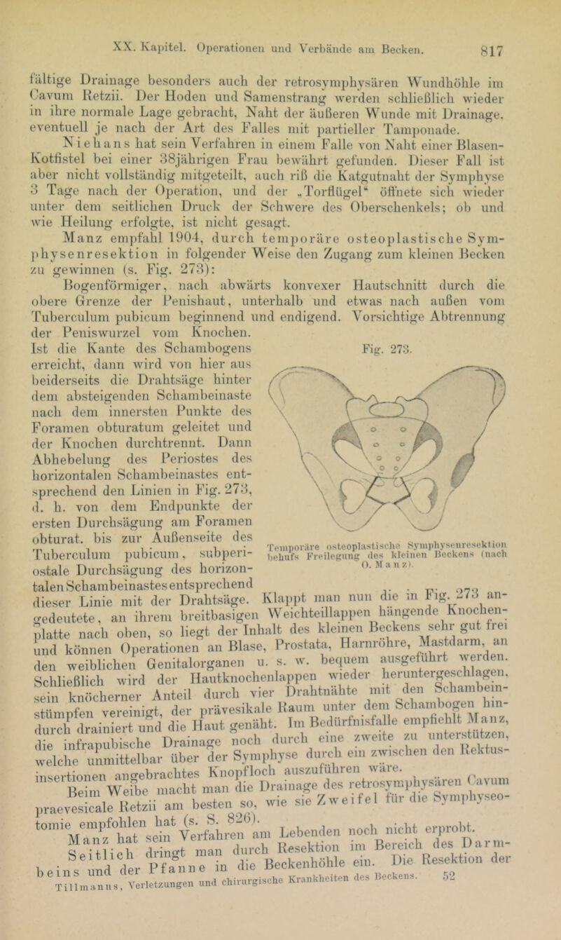 t'iiltige Cavuin Draiuage besonders auch der retrosymphysären Wundhöhle ini Ketzii. Der Hoden und Samenstrang werden schließlich wieder in ihre normale Lage gebracht, Naht der äußeren Wunde mit Drainage, eventuell je nach der Art des Falles mit })artieller Tamponade, N i e h a n s hat sein Verfahren in einem Falle von Naht einer Blasen- Kotfistel bei einer 38jährigen Frau bewährt gefunden. Dieser Fall ist aber nicht vollständig mitgeteilt, auch riß die Katgutnaht der Symphyse 3 Tage nach der Operation, und der .Torflügel“ öfthete sich wieder unter dem seitlichen Druck der Schwere des Oberschenkels; ob und Avie Heilung erfolgte, ist nicht gesagt. Manz empfahl 1904, durch temjioräre osteoplastische Sym- jihysenresektion in folgender Weise den Zugang zum kleinen Becken zu gewinnen (s. Fig. 273): Bogenförmiger, nach abwärts konvexer Hautschnitt durch die obere Grenze der Fenishaut, unterhalb und etwas nach außen vom Tuberculum pubicum beginnend und endigend. Vorsichtige Abtrennung der Feniswurzel vom Knochen. Ist die Kante des Schanibogens Fig. 273. erreicht, dann Avird von hier aus beiderseits die Drahtsäge hinter dem absteigenden Schambeinaste nach dem inner.sten Punkte des Foramen obturatum geleitet und der Knochen durchtrennt. Dann Abhebelung des Periostes des horizontalen Schambeinastes ent- sprechend den Linien in Fig. 273, d. h. von dem Endpunkte der ersten Durchsägung am Foramen obturat. bis zur Außenseite des 'ruberculum ])ubicum, .subperi- ostale Durchsägung des horizon- talen Schambeinastes entsprechend dieser Linie mit der Drahtsäge. — ^ ^ <redeutete, an ihrem breitbasigen Weichteillappen hangende Knochen- platte nach oben, so liegt der Inhalt des kleinen Beckens sehr gut rei lind können Operationen an Blase, Prostata, Harnrohre, Mastdarm an den weiblichen Genitalorganen u. s. w. bequem ausgeführt Hautknochenlappen wieder heruntergeschlagen, durch vier Drahtnähte mit den Schambein- Temporiire o.steoplastischo Syinphyseiircscktion behufs Freilegung des kleinen Beckens (nach O. AI a n 7.). Klappt man nun die m Fig. 273 an- Schließlich Avird sein knöcherner der sein knöcherner Anteil durch vier i^ranrnauit- stUmrfen vereinigt, der “*7 .‘’f durch drainiert und die Haut genäht ln; B»;l»''fn.sfn le ^ die infrapubische Drainage noch durch eine ZAveite zu unterstützen, welche unmittelbar Uber der Sym,-hyse durch ein zwischen den liektus- praer uetzii am besten so, wie sieZwe.fel für d.e hyn.,d.yseo- tomie empfohlen hat^(s. S. 820), Manz hat Seitlich b ein s und T i 11 lu a n u s, A erletzungen am Lebenden noch nicht erprobt. Resektion im Bereich des Darm- Die Resektion der 52 sein Verfahren dringt man durch der Pfanne in die Beckenhohle und chirurgische Krankheiten des Beckens. ein.