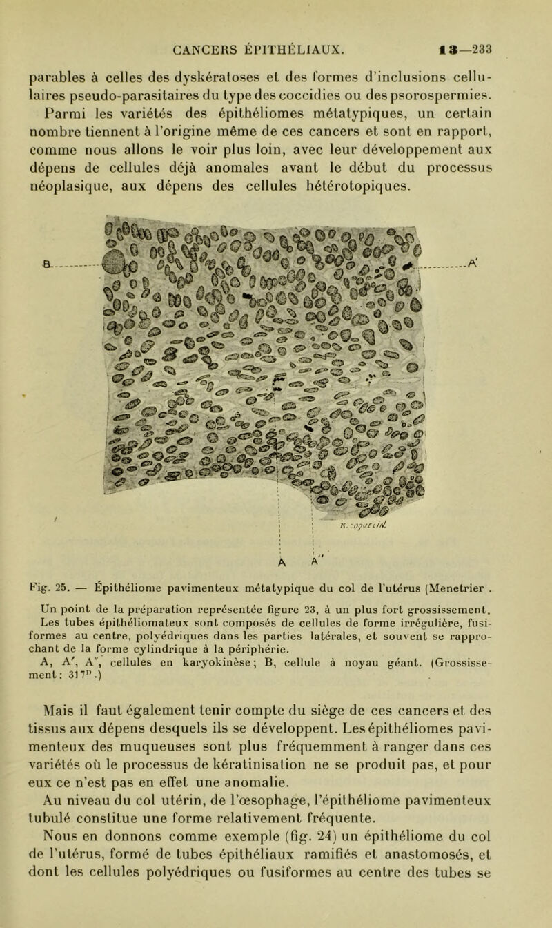 parables à celles des dyskéraloses el des formes d’inclusions cellu- laires pseudo-parasitaires du type des coccidies ou des psorospermies. Parmi les variétés des épithéliomes métatypiques, un certain nombre tiennent à l’origine même de ces cancers et sont en rapport, comme nous allons le voir plus loin, avec leur développement aux dépens de cellules déjà anomales avant le début du processus néoplasique, aux dépens des cellules hétérotopiques. B- '0 % Oc .r=- • <e & S tl» d§l K. Fig. 25. — Épithéliome pavimenteux métatypique du col de l’utérus (Menetrier . Un point de la préparation représentée figure 23, à un plus fort grossissement. Les tubes épithéliomateux sont composés de cellules de forme irrégulière, fusi- formes au centre, polyédriques dans les parties latérales, et souvent se rappro- chant de la forme cylindrique à la périphérie. A, A', A, cellules en karyokinèse; B, cellule à noyau géant. (Grossisse- ment: 31 T.) Mais il faut également tenir compte du siège de ces cancers et des tissus aux dépens desquels ils se développent. Les épithéliomes pavi- menteux des muqueuses sont plus fréquemment à ranger dans ces variétés où le processus de kératinisation ne se produit pas, et pour eux ce n’est pas en effet une anomalie. Au niveau du col utérin, de l’œsophage, l’épilhéliome pavimenteux tubulé constitue une forme relativement fréquente. Nous en donnons comme exemple (fig. 24) un épithéliome du col de l’utérus, formé de tubes épithéliaux ramifiés et anastomosés, et dont les cellules polyédriques ou fusiformes au centre des tubes se