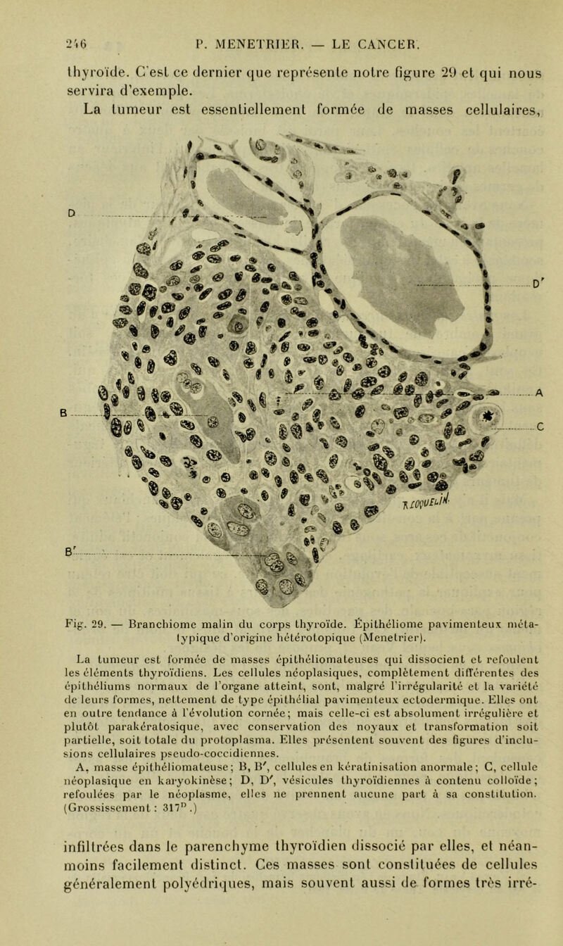 Ihyroïde. C'esL ce dernier que représenle noire figure 29 et qui nous servira d’exemple. La lumeur est essenliellemenl formée de masses cellulaires, fl « % 5» * **. x,.. 9 V 9 N ^ J «a V 5' ^ , ^ Sft' r ^ ® -y. D' ^ ^ .1®%^ -5. % , A -C ■* ® ® .. * © B'.. e ■V ® ftî( f» ,r' V t # \ , Fig. 29. Branchiomc malin du corps thyroïde. Épithéliome pavimenleux méta- lypique d’origine hétérotopique (Menetrier). La tumeur est l'ormée de masses épithéliomateuses qui dissocient et refoulent les éléments thyroïdiens. Les cellules néoplasiques, complètement différentes des épithéliums normaux de l’organe atteint, sont, malgré l’irrégularité et la variété de leurs formes, nettement de type épithélial pavimenteu.v ectodermique. Elles ont en outre tendance à l’évolution cornée; mais celle-ci est absolument irrégulière et plutôt parakératosique, avec conservation des noyaux et transformation soit partielle, soit totale du protoplasma. Elles présentent souvent des figures d’inclu- sions cellulaires pseudo-coccidiennes. A, masse épithéliomateuse ; B, B', cellules en kératinisation anormale ; C, cellule néoplasique en karyokinèse; D, D', vésicules thyroïdiennes à contenu collo’ïde; refoulées par le néoplasme, elles ne prennent aucune part à sa constitution. (Grossissement: Sn”.) infiltrées dans le parenchyme thyroïdien ilissocié par elles, et néan- moins facilement distinct. Ces masses sont constituées de cellules généralement polyédriques, mais souvent aussi de formes très irré-