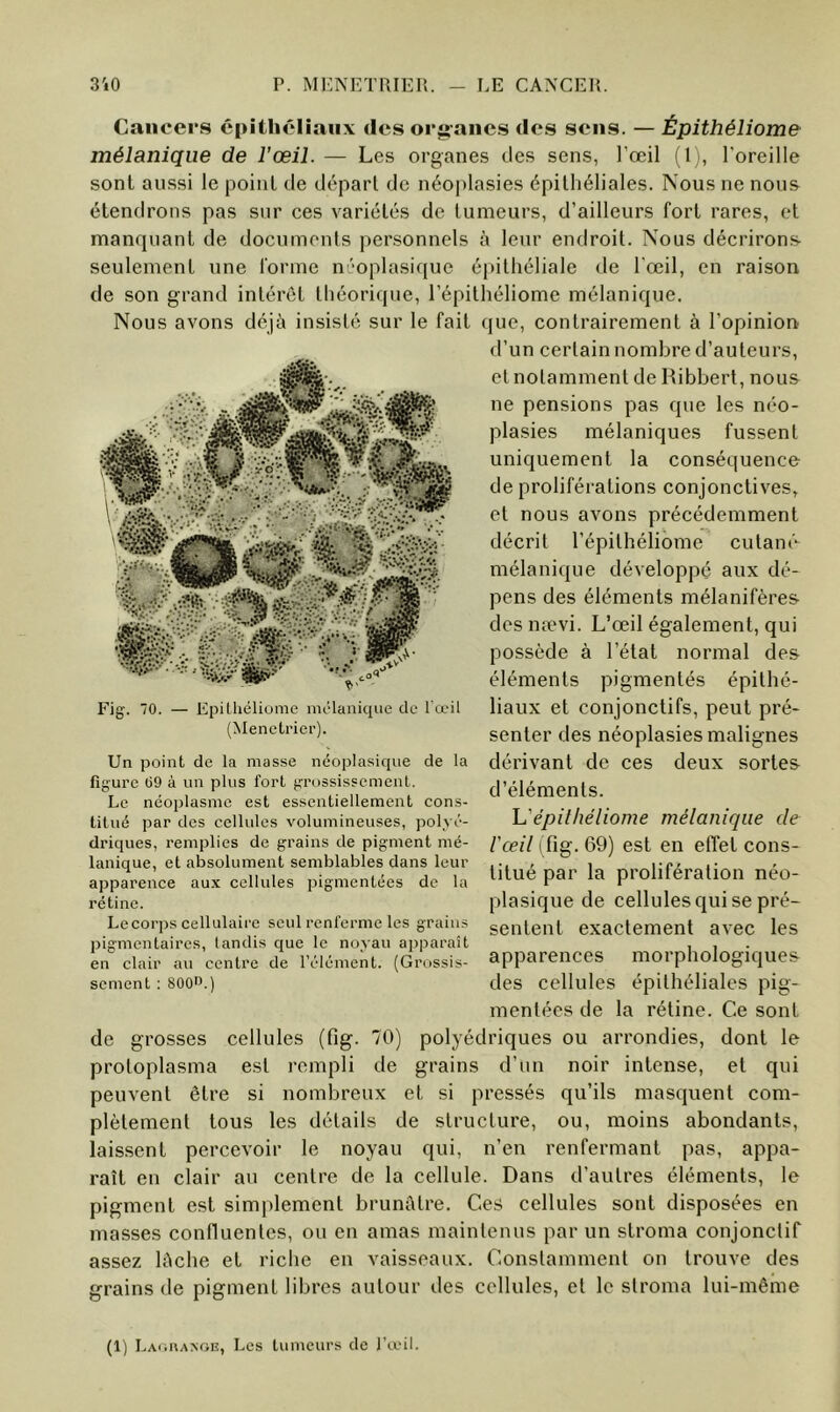 Cancers épithénaiix des orj^ancs des sens. — Épithéliome mélanique de l’œil. — Les organes des sens, l’œil (1 l'oreille sont aussi le point de départ de néoplasies épithéliales. Nous ne nous étendrons pas sur ces variétés de tumeurs, d’ailleurs fort rares, et manquant de documents personnels à leur endroit. Nous décrirons seulement une forme n'oplasique épithéliale de l'œil, en raison de son grand intérêt théorique, l’épitliéliome mélanique. Nous avons déjà insisté sur le fait que, contrairement à l’opinion d’un certain nombre d’auteurs, et notamment de Ribbert, nous ne pensions pas que les néo- plasies mélaniques fussent uniquement la conséquence de proliférations conjonctives,^ et nous avons précédemment décrit l’épithéliome cutané mélanique développé aux dé- pens des éléments mélanifères desnævi. L’œil également, qui possède à l’état normal des éléments pigmentés épithé- liaux et conjonctifs, peut pré- senter des néoplasies malignes dérivant de ces deux sortes- d’éléments. U épithéliome mélanique de l'œil (Tig. 69) est en effet cons- titué par la prolifération néo- plasique de cellules qui se pré- sentent exactement avec les apparences morphologiques des cellules épithéliales pig- mentées de la rétine. Ce sont de grosses cellules (fig. 70) polyédriques ou arrondies, dont le protoplasma est rempli de grains d’un noir intense, et qui peuvent être si nombreux et si pressés qu’ils masquent com- plètement tous les détails de structure, ou, moins abondants, laissent percevoir le noyau qui, n’en renfermant pas, appa- raît en clair au centre de la cellule. Dans d’autres éléments, le pigment est simplement brunâtre. Ces cellules sont disposées en masses confluentes, ou en amas maintenus par un stroma conjonctif assez lâche et riche en vaisseaux. Constamment on trouve des grains de pigment libres autour des cellules, et le stroma lui-même Fig. 70. — Epilliéliome mélanique de l’œil (Menetrier). Un point de la masse néoplasique de la figure 09 à un plus fort grossissement. Le néoplasme est essentiellement cons- titué par des cellules volumineuses, polyé- driques, remplies de grains de pigment mé- lanique, et absolument semblables dans leur apparence aux cellules pigmentées de la rétine. Lecorps cellulaire seul renferme les grains pigmentaires, landis que le noyau apparaît en clair au centre de l’élément. (Grossis- sement ; 800D.) (1) Laouaxoe, Les tumeurs de l’œil.