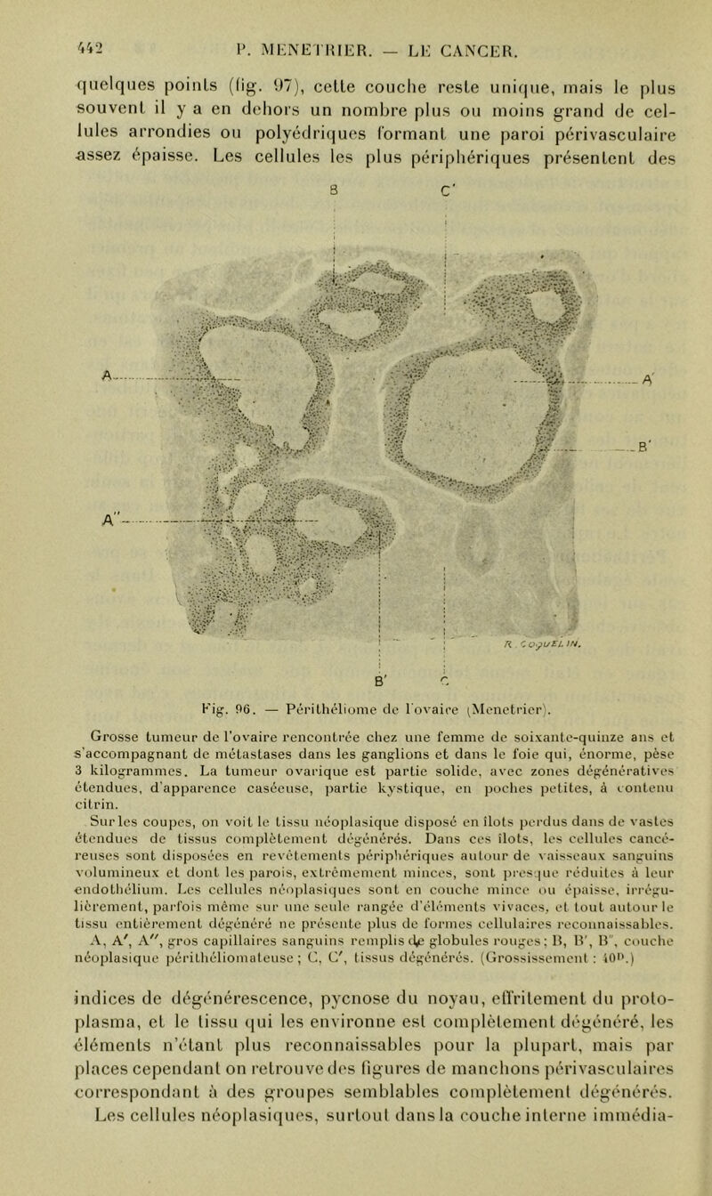 quelques points ((ig. R7), celle couche reste unique, niais le plus souvent il y a en dehors un nombre plus ou moins grand de cel- lules arrondies ou polyédri(|ues l'ormanl une paroi périvasculaire assez épaisse. Les cellules les plus périphériques présentent des 8 C' A A”-- Kig-, 96. — Périlhéliunie de l'ovaire ^Ménétrier). Grosse tumeur de l’ovaire renconti'ée chez une femme de soixante-quinze ans et s'accompagnant de métastases dans les ganglions et dans le foie qui, énorme, pèse 3 kilogrammes. La tumeur ovarique est partie solide, avec zones dégénératives étendues, d’apparence caséeuse, partie kystique, en poches petites, à contenu citrin. Surles coupes, on voit le tissu néoplasique disposé en îlots perdus dans de vastes étendues de tissus complètement dégénérés. Dans ces îlots, les cellules cancé- reuses sont disposées en revêtements périphériques autour de x aisseaux sanguins volumineux et dont les jiarois, extrêmement minces, sont presque réduites à leur endothélium. Les cellules néo]ilasiques sont en couche mince ou épaisse, irrégu- lièrement, parfois même sur une seule rangée d’éléments vivaces, et tout autour le tissu entièrement dégénéré ne présente plus de formes cellulaires reconnaissahles. A, A', A, gros capillaires sanguins remplis <.1^^ globules rouges; R, R', R, couche néoplasique périthéliomateuse ; C, G', tissus dégénérés. (Grossissement : 40i'.) ànclices de dégénérescence, pyenose du noyati, etlVilement dti proto- plasma, et le tissu (|ui les environne est complèlemenl dégénéré, les idéments n’étant plus reconnaissables pour la plupart, mais par places cependant on retrotive dt's ligures de manchons périvasculaires correspondant à des groupes semblables complèlemenl dégénérés. Les cellules néoplasiques, surtoul dattsla couche inlerne immédia-