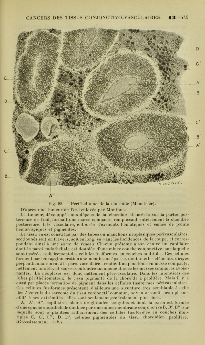 À Eig. 98. — Périllicliomc de la choroïde (Menelrier). D’après imc tumeur de l’œ.l enle' ée ])ar Moiillnis. La tumeur, développée au.\ dépens de la choroïde et insérée sur la partie j)Os- térieure de l'œil, formait une masse compacte remplissant entièrement la chambre postérieure, très vasculaire, entourée d'e.vsudats hématiques et semée de ]30ints hémori’agiqucs et pigmentés. Le tissu en est constitué par des tubes ou manchons néoplasiques péri\ asculaires. .sectionnés soit en travers, soit en long, suivant les incidences de la coupe, et corres- ])iindant ainsi à une sorte de réseau. Ch icun présente à son centre un ca|)illaire dont la paroi endothéliale est doublée d'une mince couche conjonctive, sur laquelle sont insérées radiairement des cellules fusiformes, en couches multi|)les. Ces cellules forment ])ar leuragglomération une membrane épaisse, dont tous les éléments, dirigés per])endiculairement à la jinroi vasculaire, irradient au |)Ourtour, en masse compacte, nettement limitée, et sans scconfondreaucunement avec les masses similaires avoisi- nantes. La néo])lasie est donc nettement ]iérivasculaire. Dans les interstices des tubes périthéliomateux, le tissu pigmenté de la choro'ïde a proliféré. Mais il y a aussi par places formation de pigment dans les cellules fusiformes |)érivasculaii'es. Ces cellu:es fusiformes présentent d'ailleurs une stiucture très semblalile à celle des éléments du sarcome du tissu conjonctif commun, noyau arrondi, iirotojilasina eflilé à ses extrémités; elles sont seulement généralement plus Unes. A, A', A, capillaires pleins de globules sanguins et dont la paroi est formée d'une couche endothéliale doublée ])ar une mince membrane eonjoncii velî, I!'. R, sur hnpielle sont implantées radiairement des cellules fusiformes en couches mul- tiples C, C', D, D', cellules ])igmentées du tissu choro'ïdien proliféré. (Grossissement : 97i’.)