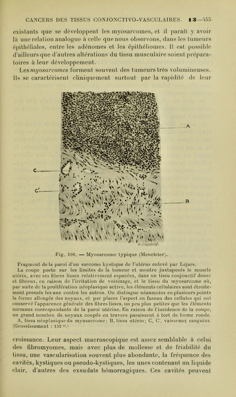 cxislaiils que se dévoloppenl les myosarcomes, el il paraîl y avoir là unerelalion analogue à celle que nous observons, dans les lumeurs épitliéliales, entre les adénomes el les épilhéliomes. 11 est possible d’aillcursque d’autres altérations du lissu musculaire soient prépara- toires à leur développement. \^esmijoscircomes forment souvent ries lumeurs très volumineuses. Us se caractérisent clinicpicment surtout par la rapidité de leur Fig. 100. — Myosarcome typique (Menetrier). Fragment delà paroi d’un sarcome kystique de l’utérus enlevé par Lejars. La coupe porte sur les limites de la tumeur et montre juxtaposés le muscle utérin, avec ses fibres lisses relativement espacées, dans un lissu conjonctif dense el fibreux, en raison de l’irritation de voisinage, et le lissu du myosarcome où, par suite de la prolifération néoplasique active, les éléments cellulaires sont étroite- ment pressés les uns contre les autres. On distingue néanmoins en plusieurs points la forme allongée des noyaux, et par places l’aspect en fuseau des cellules qui ont conservé l’apparence générale des fibres lisses, un peu plus petites que les éléments normaux correspondants de la paroi utérine. En raison de l’incidence de la coupe, un grand nombre de noyaux coupés en travers paraissent à tort de forme ronde. A, tissu néoplasique du myosarcome; R, lissu utérin; G, G', vaisseaux sanguins. (Grossissement : 152 croissance. Leur aspect macroscopique est assez semblable à celui des fibromyomes, mais avec plus de mollesse el de friabilité du lissu, une vascularisation souvent plus abondante, la fréquence des cavités, kystiques ou pseudo-kystiques, les unes contenant un liquide clair, d’autres des exsudais hémorragiques. Ces cavités peuvent