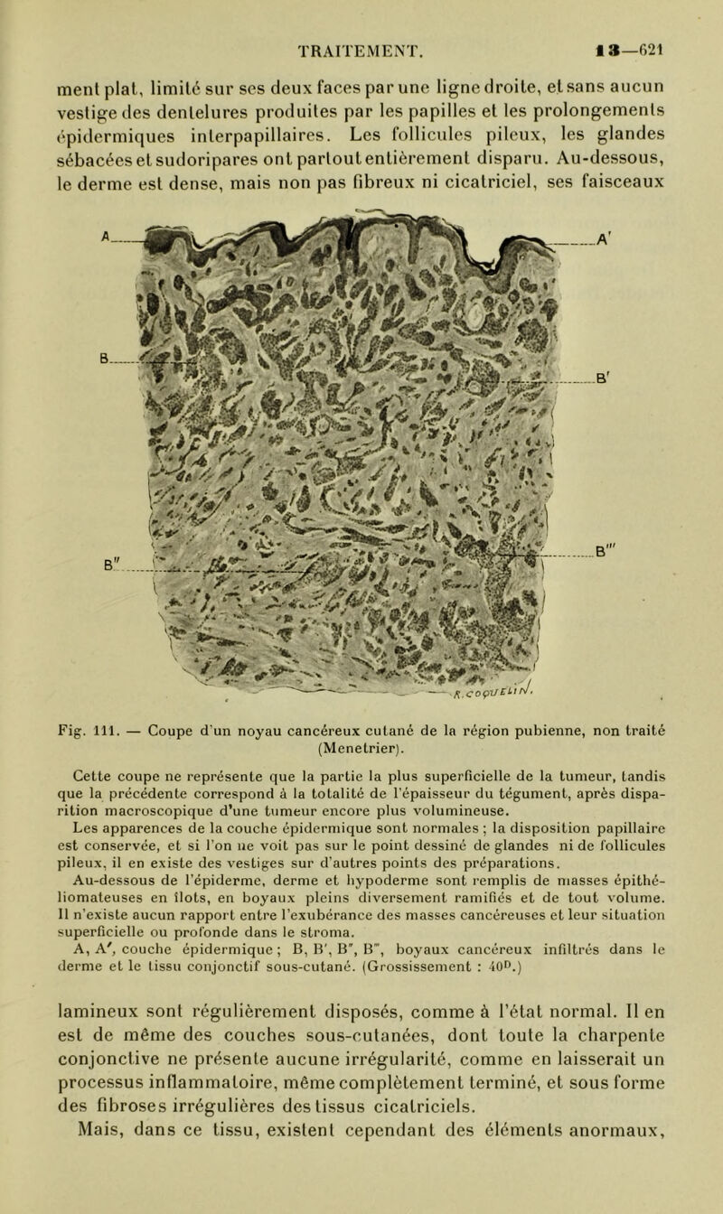 menl plat, limité sur ses deux faces par une ligne droite, et sans aucun vestige des dentelures produites par les papilles et les prolongements épidermiques interpapillaires. Les follicules pileux, les glandes sébacées et sudoripares ont partout entièrement disparu. Au-dessous, le derme est dense, mais non pas fibreux ni cicatriciel, ses faisceaux Fig. 111. — Coupe d'un noyau cancéreux cutané de la région pubienne, non traité (Menetrier). Cette coupe ne représente que la partie la plus superficielle de la tumeur, tandis que la précédente correspond à la totalité de l’épaisseur du tégument, après dispa- rition macroscopique d’une tumeur encore plus volumineuse. Les apparences de la couche épidermique sont normales ; la disposition papillaire est conservée, et si l’on ne voit pas sur le point dessiné de glandes ni de follicules pileux, il en existe des vestiges sur d’autres points des préparations. Au-dessous de l'épiderme, derme et hypoderme sont remplis de niasses épithé- liomateuses en îlots, en boyaux pleins diversement ramifiés et de tout volume. 11 n’existe aucun rapport entre l’exubérance des masses cancéreuses et leur situation superficielle ou profonde dans le stroma. A, A', couche épidermique; B, B', B, B, boyaux cancéreux infiltrés dans le derme et le tissu conjonctif sous-cutané. (Grossissement : 40^^.) lamineux .sont régulièrement disposés, comme à l’état normal. 11 en est de même des couches sous-cutanées, dont toute la charpente conjonctive ne présente aucune irrégularité, comme en laisserait un processus inflammatoire, même complètement terminé, et sous forme des fibroses irrégulières des tissus cicatriciels. Mais, dans ce tissu, existent cependant des éléments anormaux.