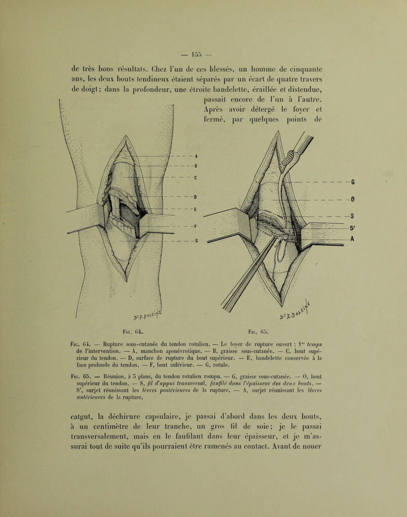 de très bons résullals. Chez ruii de ces blessés, un homme de cinquante ans, les deux bouts lendineux étaient séparés par un écart de quatre travers de doigt; dans la profondeur, une étroite bandelette, éraillée et distendue, passait encore de l’un à l’autre. Après avoir détergé le foyer et fermé, par quelques points de Fio. 04. Fig. 05. Fig, 04. — Rupture sous-cutanée du tendon rotulien. — Le foyer de rupture ouvert : 1'' temps de l’intervention. — A, manchon aponévrotique. ■— B, graisse sous-cutanée. — G, bout supé- rieur du tendon. — D, surface de rupture du bout supérieur. — E, bandelette conservée à la face profonde du tendon, — F, bout inférieur. — G, rotule. Fig. 05. — Réunion, à 5 plans, du tendon rotulien rompu. — G, graisse sous-cutanée. — O, bout supérieur du tendon. — S, fd d’appui transversal, faufilé dans l’épaisseur des deux bouts. — S', surjet réunissant les lèvres postérieures de la rupture, — A, surjet réunissant les lèvres antérieures de la rupture. catgut, la déchirure capsulaire, je passai d’abord dans les deux bouts, à un centimètre de leur tranche, un gros fil de soie; je le passai transversalement, mais en le faufilant dans leur épaisseur, et je m’as- surai tout de suite qu’ils pourraient être ramenés au contact. Avant de nouer