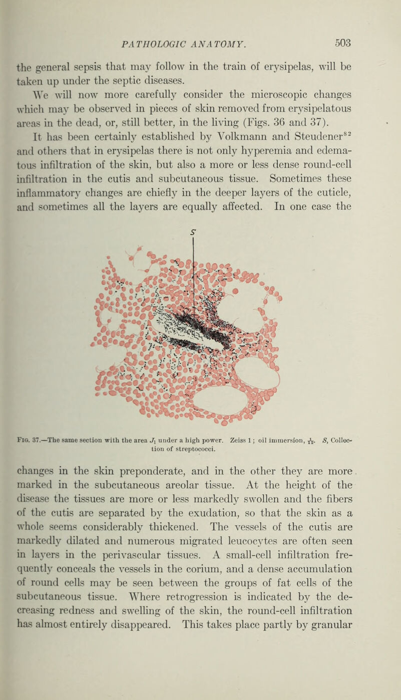 the general sepsis that may follow in the train of erysipelas, will be taken up under the septic diseases. ^^'e will now more carefull)^ consider the microscopic changes which may be observed in pieces of skin removed from erysipelatous areas in the dead, or, still better, in the living (Figs. 36 and 37). It has been certainly established by Volkmann and Steudener®^ anil others that in erysipelas there is not only hyperemia and edema- tous infiltration of the skin, but also a more or less dense round-cell infiltration in the cutis and subcutaneous tissue. Sometimes these inflammatory changes are chiefly in the deeper layers of the cuticle, and sometimes all the layers are equally affected. In one case the s- Fig. 37.—The same section with the area J-i under a high power, Zeiss 1; oil immersion, S, Collec- tion of streptococci. changes in the skin preponderate, and in the other they are more marked in the subcutaneous areolar tissue. At the height of the disease the tissues are more or less markedly swollen and the fibers of the cutis are separated by the exudation, so that the skin as a whole seems considerably thickened. The vessels of the cutis are markedly dilated and numerous migrated leucocytes are often seen in layers in the perivascular tissues. A small-cell infiltration fre- quently conceals the vessels in the corium, and a dense accumulation of round cells may be seen between the groups of fat cells of the subcutaneous tissue. Where retrogression is indicated by the de- creasing redness and swelling of the skin, the round-cell infiltration has almost entirely disappeared. This takes place partly by granular