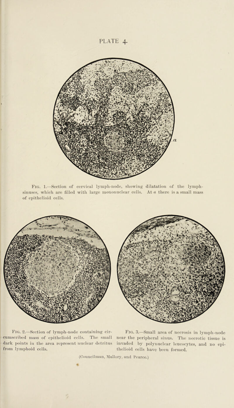 Fici. 1.—Section of cervical lym])li-no(l(‘, showinj? dilatation of the lynijdi- sinnses, which are filled with larj^e mononuclear cells. At a tlierc is a small mass of epithelioid cells. Fig. 2.—Section of lymph-node containiiiff cir- cumscribed mass of i‘]>ithelioid cidls. The small dark ]toints in the area represent nuclear detritus from lymphoid cells. FiCr. 3.—Small area of ni'crosis in lymjth-node near the periplieral sinus. 'Phe necrotic tissue is invaded hy ])olynuclear leucocytes, and no epi- thelioid cells have been formed.