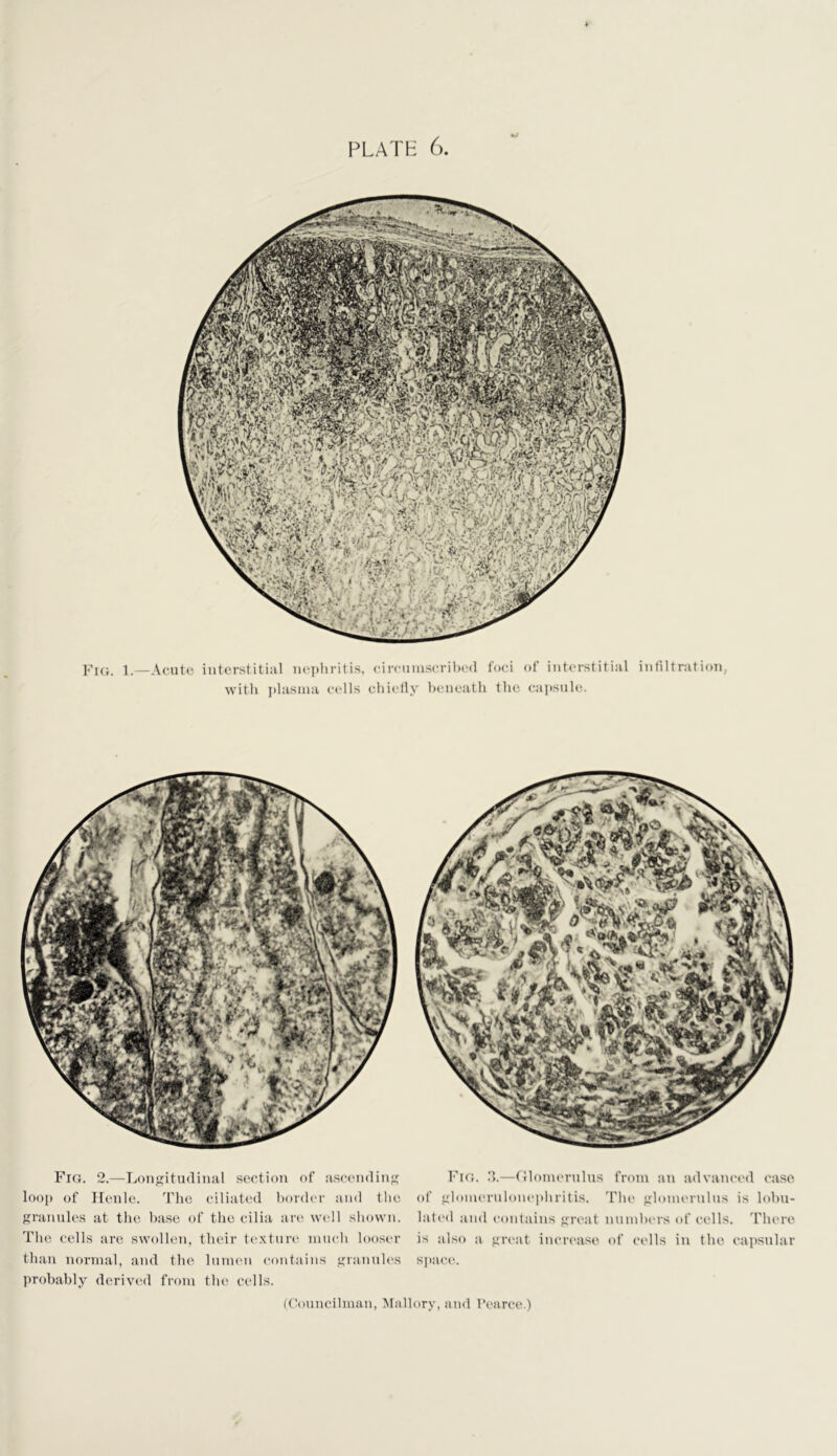 PLATH 6. mJ 1.—Acutii interstitial n(“])hritis, (ni'cuin.seril)c(l foci of interstitial infiltration, with plasma cells chiefly beneath the capsnh',. Fro. 2.—Longitudinal section of ascending loop of Jlenle. 'Phe ciliated border and tlie grannies at the base of the cilia aia* wcdl sliown. The cells are swollen, their texture nuieh looser than normal, and the lumen contains grannies probably deriv(Ml from the cells. PTc'r. d.—(Jlonu'rulus from an advanced case of glonn'rnloiu'phritis. The glomernlns is lobu- lated and contains great numbers of cells. 'Phere is also a great increase of cells in the capsular space.